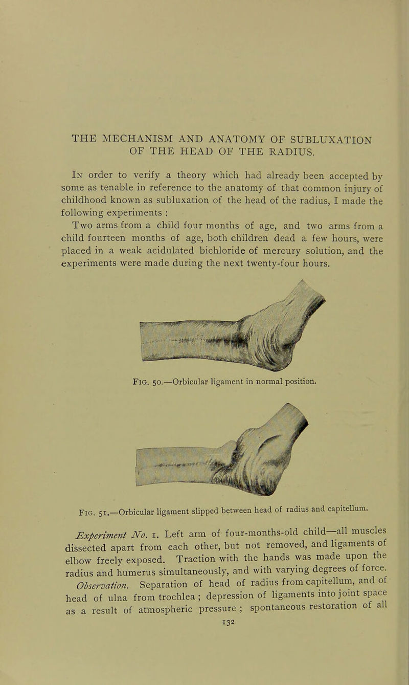 THE MECHANISM AND ANATOMY OF SUBLUXATION OF THE HEAD OF THE RADIUS. In order to verify a theory which had already been accepted by some as tenable in reference to the anatomy of that common injury of childhood known as subluxation of the head of the radius, I made the following experiments : Two arms from a child four months of age, and two arms from a child fourteen months of age, both children dead a few hours, were placed in a weak acidulated bichloride of mercury solution, and the experiments were made during the next twenty-four hours. Fig. 50.—Orbicular ligament in normal position. Fig. 51.—Orbicular ligament slipped between head of radius and capitellum. Experiment No. i. Left arm of four-months-old child—all muscles dissected apart from each other, but not removed, and ligaments of elbow freely exposed. Traction with the hands was made upon the radius and humerus simultaneously, and with varying degrees of force. Observation. Separation of head of radius from capitellum, and of head of ulna from trochlea ; depression of ligaments into joint space as a result of atmospheric pressure ; spontaneous restoration of all