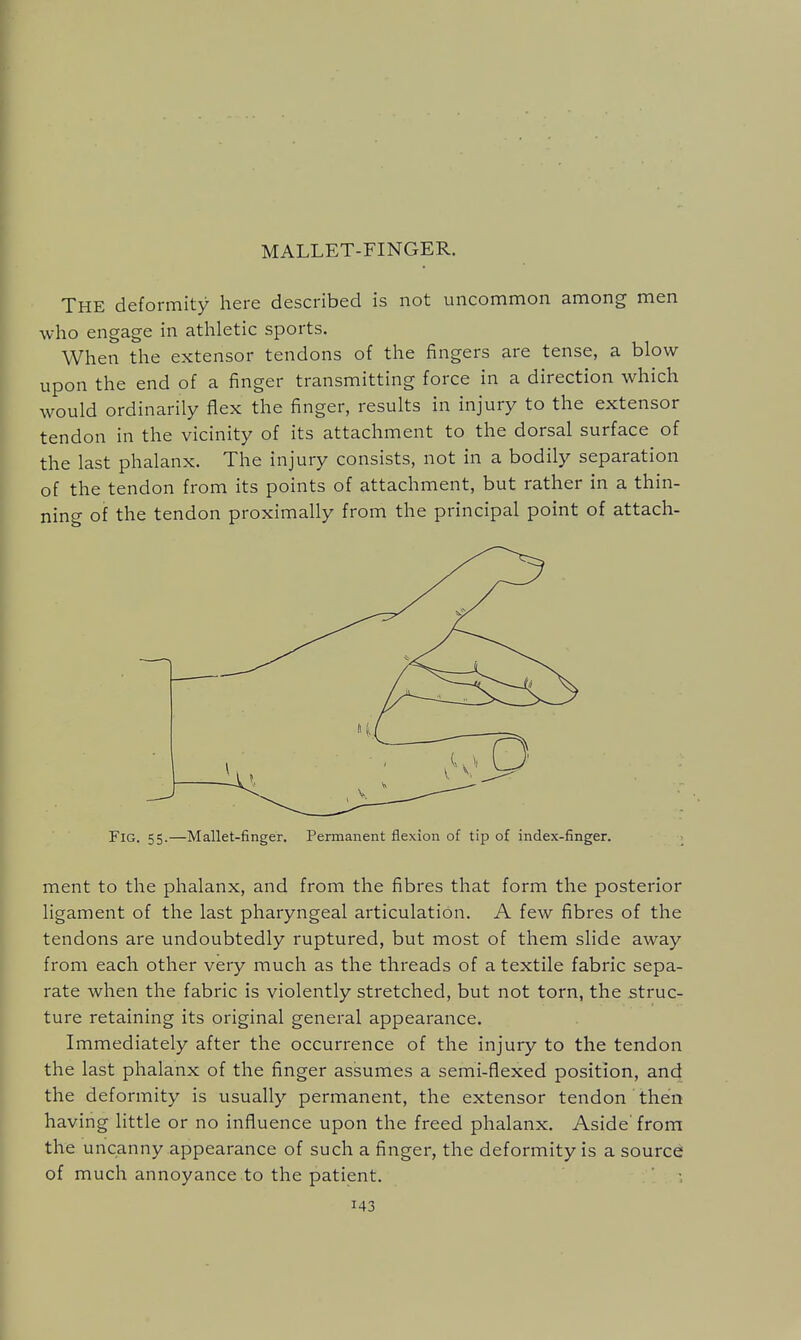 MALLET-FINGER. The deformity here described is not uncommon among men who engage in athletic sports. When the extensor tendons of the fingers are tense, a blow upon the end of a finger transmitting force in a direction which would ordinarily flex the finger, results in injury to the extensor tendon in the vicinity of its attachment to the dorsal surface of the last phalanx. The injury consists, not in a bodily separation of the tendon from its points of attachment, but rather in a thin- ning of the tendon proximally from the principal point of attach- Fig. 55.—Mallet-finger. Permanent flexion of tip of index-finger. ; ment to the phalanx, and from the fibres that form the posterior ligament of the last pharyngeal articulation. A few fibres of the tendons are undoubtedly ruptured, but most of them slide away from each other very much as the threads of a textile fabric sepa- rate when the fabric is violently stretched, but not torn, the struc- ture retaining its original general appearance. Immediately after the occurrence of the injury to the tendon the last phalanx of the finger assumes a semi-flexed position, and the deformity is usually permanent, the extensor tendon then having little or no influence upon the freed phalanx. Aside' from the uncanny appearance of such a finger, the deformity is a source; of much annoyance to the patient. ' •