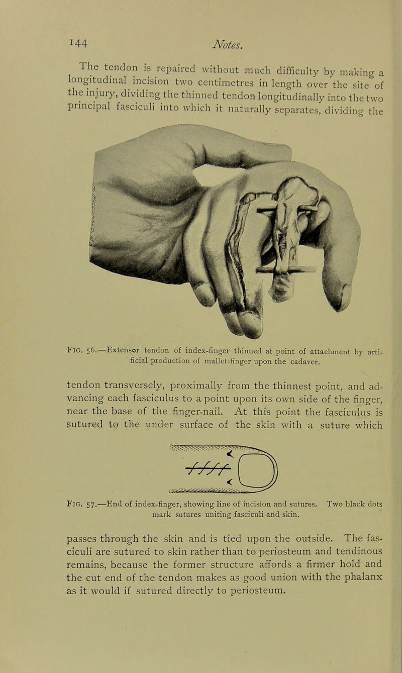 The tendon is repaired without much difficulty by making a longitudinal incision two centimetres in length over the site of the injury, dividing the thinned tendon longitudinally into the two principal fasciculi into which it naturally separates, dividing the Fig. 56.—Extensor tendon of index-finger thinned at point of attachment by arti- ficial production of mallet-finger upon the cadaver. tendon transversely, proximally from the thinnest point, and ad- vancing each fasciculus to a point upon its own side of the finger, near the base of the finger-nail. At this point the fasciculus is sutured to the under surface of the skin with a suture which Fig. 57.—End of index-finger, showing line of incision and sutures. Two black dots mark sutures uniting fasciculi and skin. passes through the skin and is tied upon the outside. The fas- ciculi are sutured to skin rather than to periosteum and tendinous remains, because the former structure afTords a firmer hold and the cut end of the tendon makes as good union with the phalanx as it would if sutured directly to periosteum.