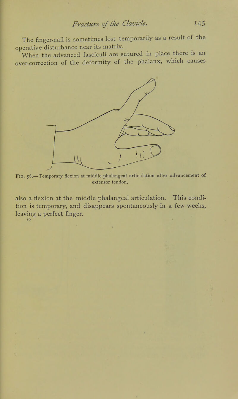 The finger-nail is sometimes lost temporarily as a result of the operative disturbance near its matrix. When the advanced fasciculi are sutured in place there is an over-correction of the deformity of the phalanx, which causes Fig. 58.—Temporary flexion at middle phalangeal articulation after advancement of extensor tendon. also a flexion at the middle phalangeal articulation. This condi- tion is temporary, and disappears spontaneously in a few weeks, leaving a perfect finger. 10