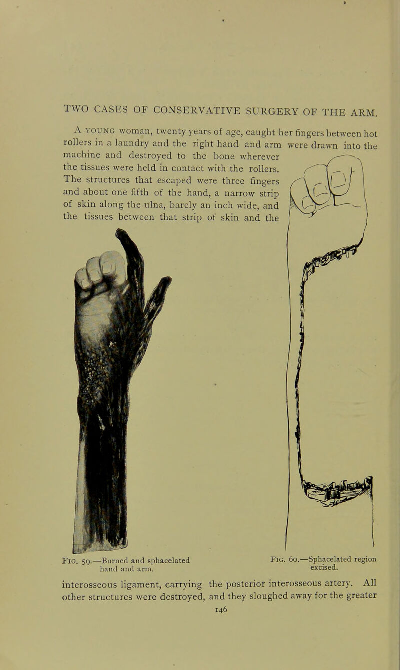 TWO CASES OF CONSERVATIVE SURGERY OF THE ARM. A YOUNG woman, twenty years of age, caught her fingers between hot rollers in a laundry and the right hand and arm were drawn into the machine and destroyed to the bone wherever the tissues were held in contact with the rollers. The structures that escaped were three fingers and about one fifth of the hand, a narrow strip of skin along the ulna, barely an inch wide, and the tissues between that strip of skin and the Fig. 59.—Burned and sphacelated hand and arm. Fig. 60.—Sphacelated region excised. interosseous ligament, carrying the posterior interosseous artery. All other structures were destroyed, and they sloughed away for the greater