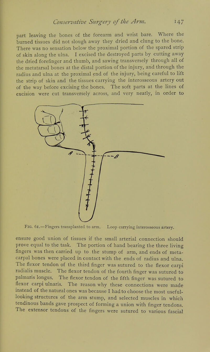 part leaving the bones of the forearm and wrist bare. Where the burned tissues did not slough away they dried and clung to the bone. There was no sensation below the proximal portion of the spared strip of skin along the ulna. I excised the destroyed parts by cutting away the dried forefinger and thumb, and sawing transversely through all of the metatarsal bones at the distal portion of the injury, and through the radius and ulna at the proximal end of the injury, being careful to lift the strip of skin and the tissues carrying the interosseous artery out of the way before excising the bones. The soft parts at the lines of excision were cut transversely across, and very neatly, in order to Fig. 61.—Fingers transplanted to arm. Loop carrying interosseous artery. ensure good union of tissues if the small arterial connection should prove equal to the task. The portion of hand bearing the three living fingers was then carried up to the stump of arm, and ends of meta- carpal bones were placed in contact with the ends of radius and ulna. The flexor tendon of the third finger was sutured to the flexor carpi radialis muscle. The flexor tendon of the fourth finger was sutured to palmaris longus. The flexor tendon of the fifth finger was sutured to flexor carpi ulnaris. The reason why these connections were made instead of the natural ones was because I had to choose the most useful- looking structures of the arm stump, and selected muscles in which tendinous bands gave prospect of forming a union with finger tendons. The extensor tendons of the fingers were sutured to various fascial