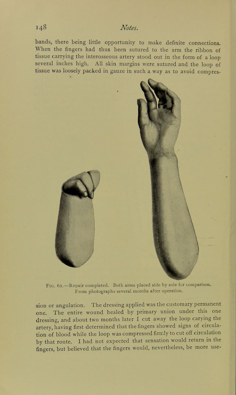 bands, there being little opportunity to make definite connections. When the fingers had thus been sutured to the arm the ribbon of tissue carrying the interosseous artery stood out in the form of a loop several inches high. All skin margins v/ere sutured and the loop of tissue was loosely packed in gauze in such a way as to avoid compres- FiG. 62.—Repair completed. Both arms placed side by side for comparison. From photographs several months after operation. sion or angulation. The dressing applied was the customary permanent one. The entire wound healed by primary union under this one dressing, and about two months later I cut away the loop carying the artery, having first determined that the fingers showed signs of circula- tion of blood while the loop was compressed firmly to cut off circulation by that route. I had not expected that sensation Avould return in the fingers, but believed that the fingers would, nevertheless^ be more use-