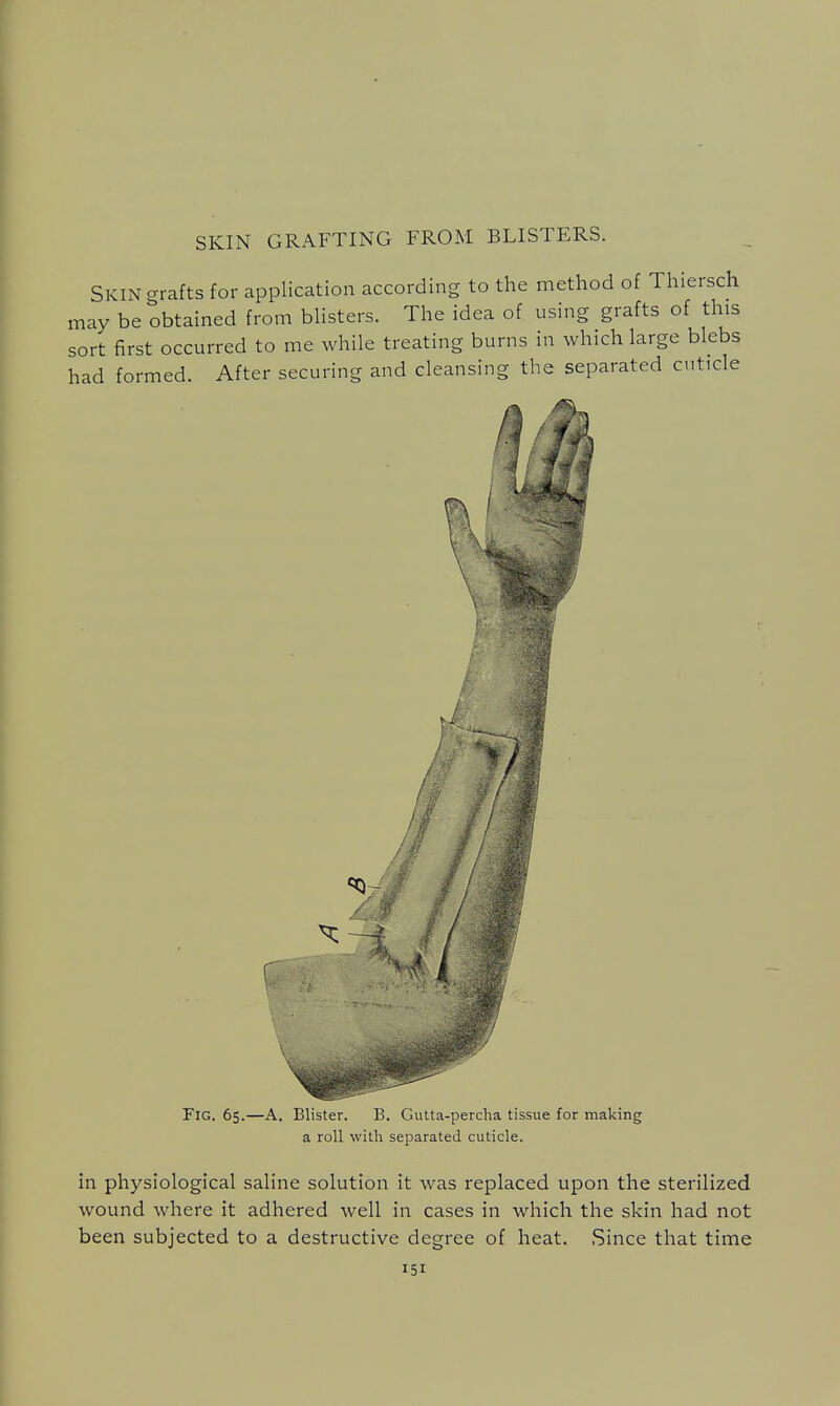 SKIN GRAFTING FROM BLISTERS. Skin crrafts for application according to the method of Thiersch may be obtained from blisters. The idea of using grafts of this sort first occurred to me while treating burns in which large blebs had formed. After securing and cleansing the separated cuticle Fig. 65.—A. Blister. B. Gutta-percha tissue for making a roll with separated cuticle. in physiological saline solution it was replaced upon the sterilized wound where it adhered well in cases in which the skin had not been subjected to a destructive degree of heat. Since that time