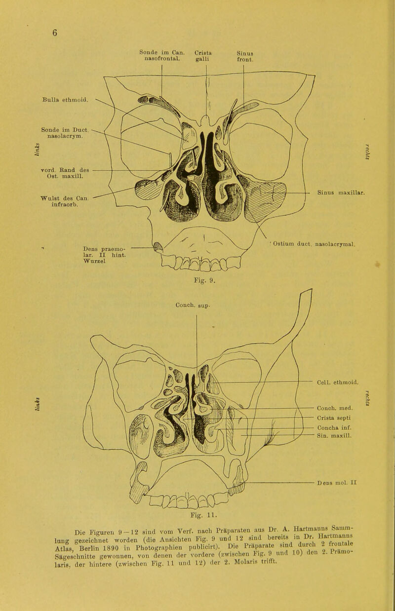 Sonde im Can nasofrontal. Cri8tu galli Bulla ethmoid. Sonde im Duet. nasolacrym. vord. Band des Ost. maxill. Wulst des Can. infraorb. Sinus maxillar. Dens praeino- lar. II hint Wurzel Ostium duct. nasolacrymal. Fig. 9. Couch, sup- Cell, ethmoid. Conch. med. Crista septi Conoha inf. Sin. maxill. Dens mol. II Fig. 11. Die Figuren 9-12 sind vom Verf. nach Präparaten aus Dr. A. Hartmanns Samm- lang gezeichnet worden (die Ansichten Fig. 9 und 12 sind bereits iu Dr HKU»au AtlL, Berlin 1890 in Photographien publioirt). Die Präparate «md durch 2 frontale Sägeschnitte gewonnen, von denen der vordere (/.wischen lig. 9 und 10) den 2. I ramo laris. der hintere (zwisohen Fig. 11 und 12) der 2. Molaris trifft.