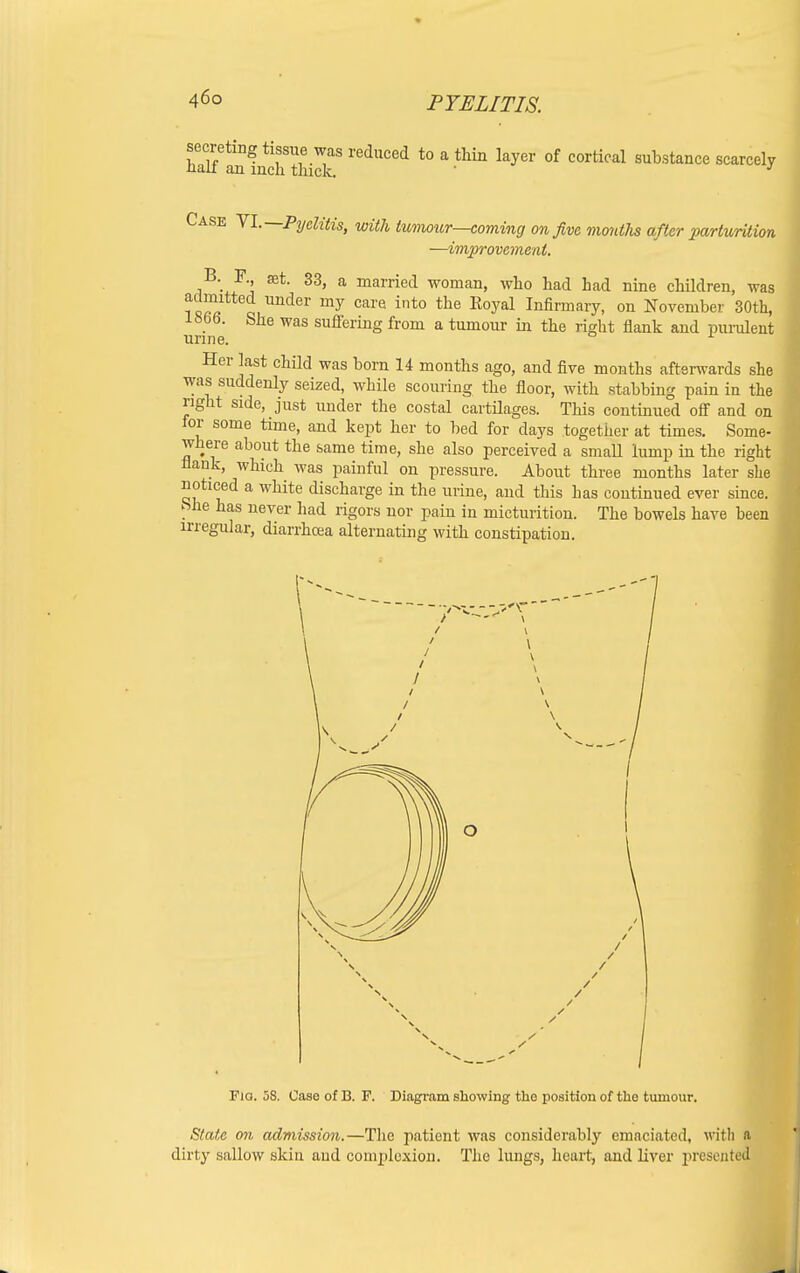 secreting tissue was reduced to a thin layer of cortical substance scarcely nail an inch thick. ' 1 Case VI.—Pyelitis, with tumour—coming on five months after parturition —improvement. B. F set. 33, a married woman, who had had nine children, was J2? „ Under my Cai'e int° the Royal Infirmary. on November 30th, 1866. She was suffering from a tumour in the right flank and purulent urine. 1 Her last child was born 14 months ago, and five months afterwards she was suddenly seized, while scouring the floor, with stabbing pain in the right side, just under the costal cartilages. This continued off and on for some time, and kept her to bed for days together at times. Some- where about the same time, she also perceived a small lump in the right flank, which was painful on pressure. About three months later she noticed a white discharge in the urine, and this has continued ever since. bhe has never had rigors nor pain in micturition. The bowels have been irregular, diarrhoea alternating with constipation. Fia. 58. Case of B. F. Diagram showing the position of the tumour. State on admission.—The patient was considerably emaciated, with ft dirty sallow skin and complexion. The lungs, heart, and liver present®