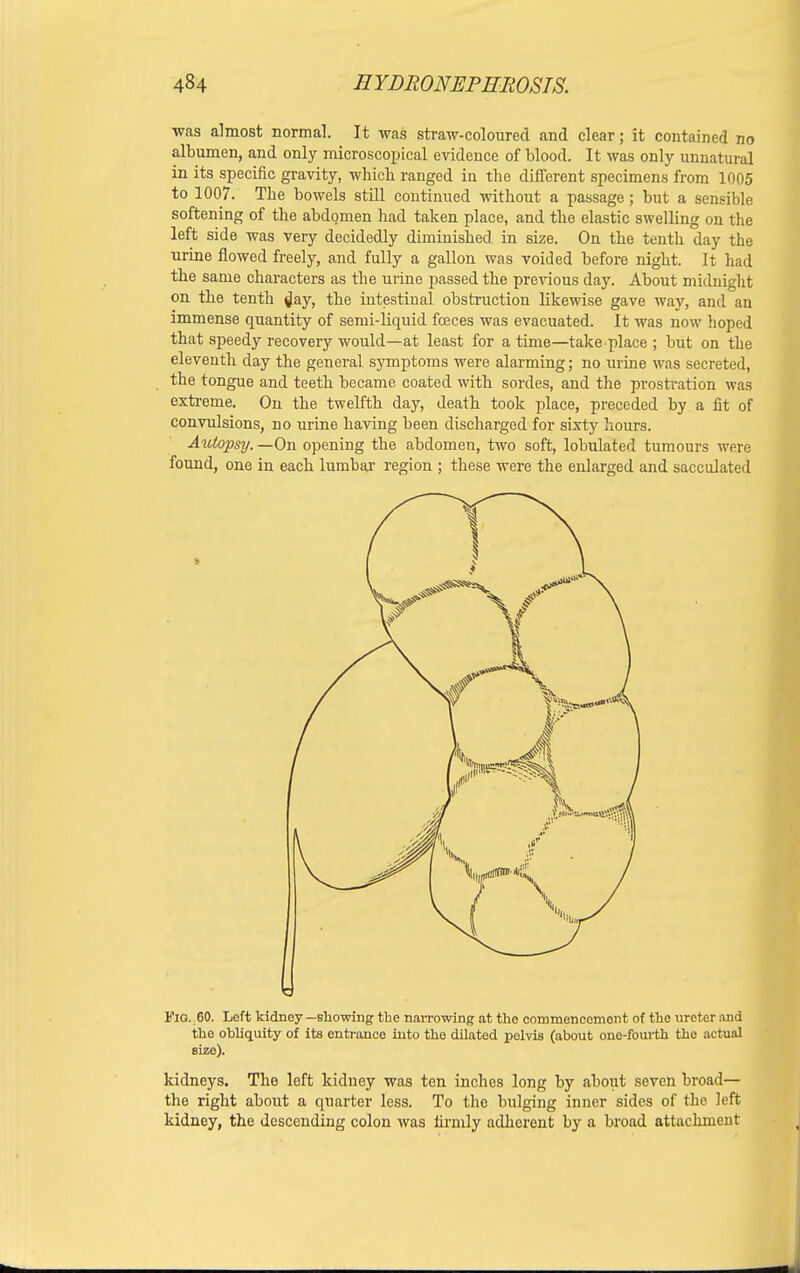 was almost normal. It was straw-coloured and clear; it contained no albumen, and only microscopical evidence of blood. It was only unnatural in its specific gravity, which ranged in the different specimens from 1005 to 1007. The bowels still continued without a passage; but a sensible softening of the abdomen had taken place, and the elastic swelling on the left side was very decidedly diminished in size. On the tenth day the urine flowed freely, and fully a gallon was voided before night. It had the same characters as the urine passed the previous day. About midnight on the tenth day, the intestinal obstruction likewise gave way, and an immense quantity of semi-liquid feces was evacuated. It was now hoped that speedy recovery would—at least for a time—take place ; but on the eleventh day the general symptoms were alarming; no urine was secreted, the tongue and teeth became coated with sordes, and the prostration was extreme. On the twelfth day, death took place, preceded by a lit of convulsions, no urine having been discharged for sixty hours. Autopsy. —On opening the abdomen, two soft, lobulated tumours were found, one in each lumbar region ; these were the enlarged and sacculated - Via. 60. Left kidney—showing the narrowing at the commencement of the ureter and the obliquity of its entrance into the dilated pelvis (about one-fourth the actual size). kidneys. The loft kidney was ten inches long by about seven broad— the right about a quarter less. To the bulging inner sides of the left kidney, the descending colon was iirmly adherent by a broad attachment _.