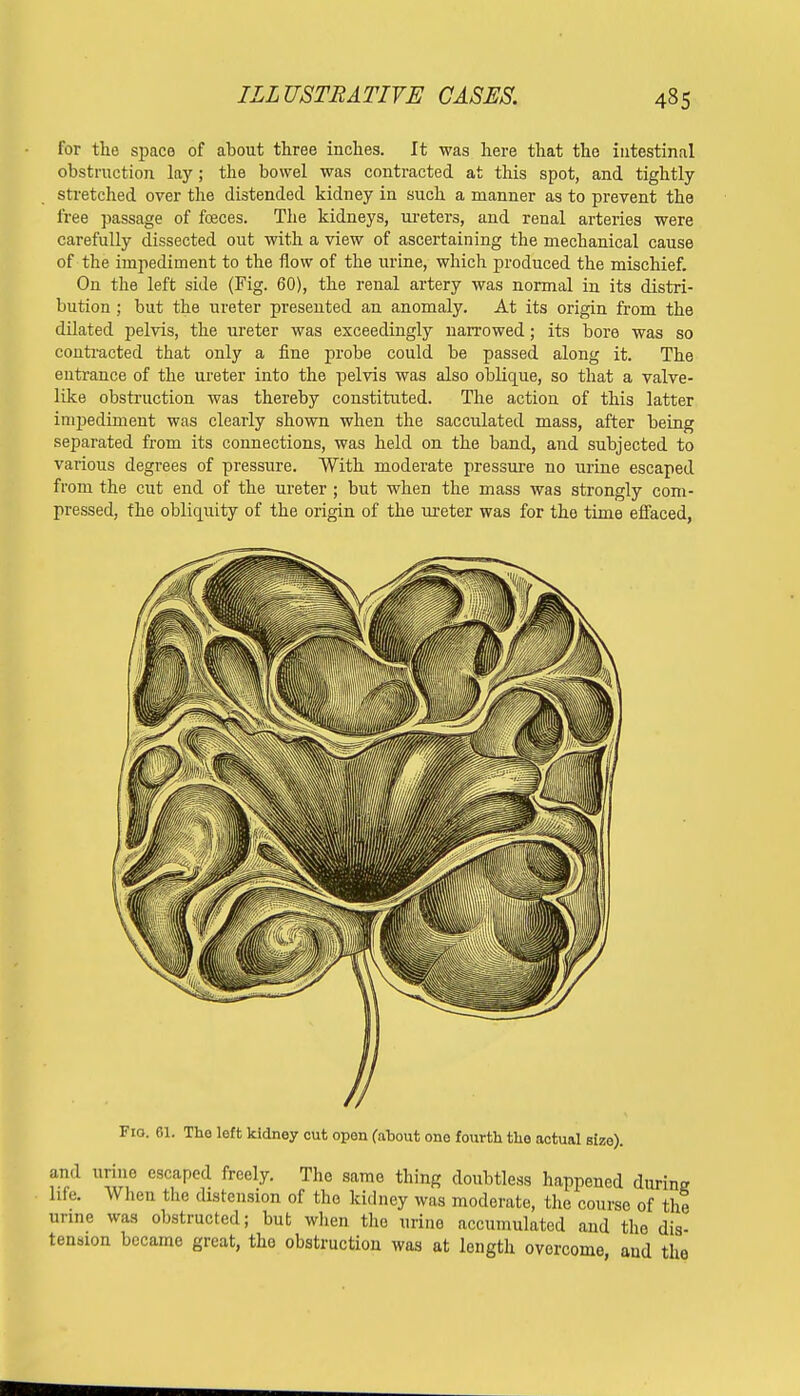 for the space of about three inches. It was here that the intestinal obstruction lay; the bowel was contracted at this spot, and tightly- stretched over the distended kidney in such a manner as to prevent the free passage of fceces. The kidneys, ureters, and renal arteries were carefully dissected out with a view of ascertaining the mechanical cause of the impediment to the flow of the urine, which produced the mischief. On the left side (Fig. 60), the renal artery was normal in its distri- bution ; but the ureter presented an anomaly. At its origin from the dilated pelvis, the ureter was exceedingly narrowed; its bore was so contracted that only a fine probe could be passed along it. The entrance of the ureter into the pelvis was also oblique, so that a valve- like obstruction was thereby constituted. The action of this latter impediment was clearly shown when the sacculated mass, after being separated from its connections, was held on the band, and subjected to various degrees of pressure. With moderate pressure no urine escaped from the cut end of the ureter ; but when the mass was strongly com- pressed, the obliquity of the origin of the ureter was for the time effaced, Fio. 61. The left kidney cut open (about one fourth the actual size). and urine escaped freely. The same thing doubtless happened during life. When the distension of the kidney was moderate, the course of the urine was obstructed; but when the urine accumulated and the dis- tension became great, tho obstruction was at length overcome and the