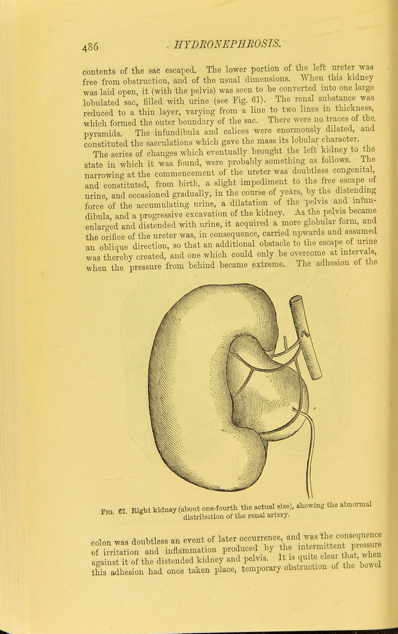 contents of the sac escaped. The lower portion of the left ureter was free from obstruction, and of the usual dimensions. When this kidney was laid open, it (with the pelvis) was seen to be converted into one large lobulated sac, filled with urine (see Fig. 61). The renal substance was reduced to a thin layer, varying from a lino to two lines m thickness, which formed the outer boundary of the sac. There were no traces ot the. pyramids. The infundibula and calices were enormously ddated, and constituted the sacculations which gave the mass its lobular character. The series of changes which eventually brought the left kidney to the state in which it was found, were probably something as follows, lne narrowing at the commencement of the ureter was doubtless congenital and constituted, from birth, a slight impediment to the free escape of urine, and occasioned gradually, in the course of years, by the distending force of the accumulating urine, a dilatation of the pelvis and infun- dibula, and a progressive excavation of the kidney. As the pelvis became enlarged and distended with urine, it acquired a more globular form, and the orifice of the ureter was, in consequence, carried upwards and assumed an oblique direction, so that an additional obstacle to the escape of urine was thereby created, and one which could only be overcome at intervals, when the pressure from behind became extreme. The adhesion of the FIQ 62 Bight kidney (about one-fourth the actual size), showing the abnormal 6 distribution of the renal artery. colon was doubtless an event of ^^T^^Zr^TZZ of irritation and inflammation produced by the JfT* against it of the distended kidney and pelvis. It is quite cbar that, v, hen this adhesion had once taken place, temporary obstruction of the bond