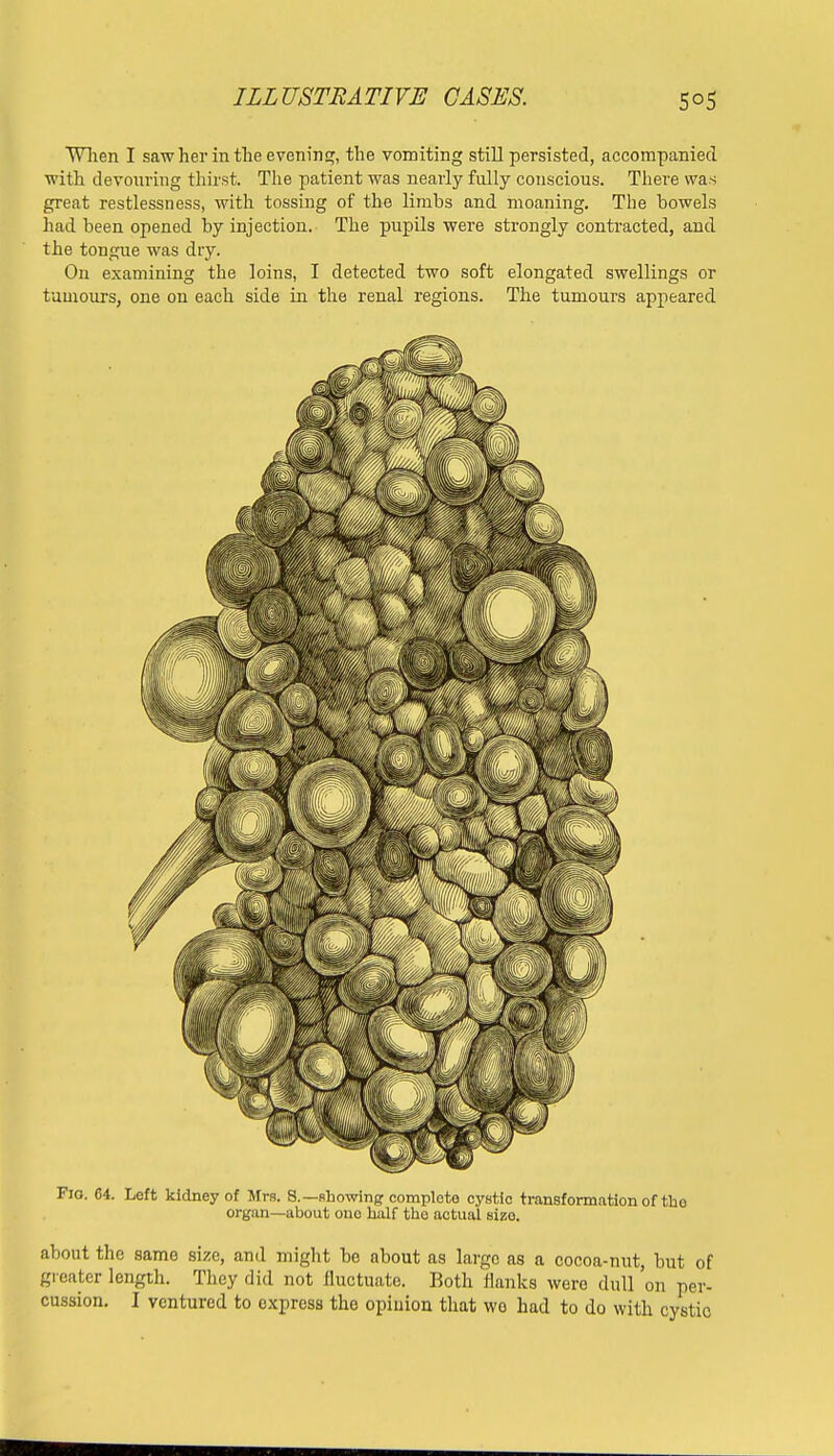 When I saw her in the evening, the vomiting still persisted, accompanied with devouring thirst. The patient was nearly fully conscious. There was great restlessness, with tossing of the limbs and moaning. The bowels had been opened by injection. The pupils were strongly contracted, and the tongue was dry. On examining the loins, I detected two soft elongated swellings or tumours, one on each side in the renal regions. The tumours appeared Fio. 64. Left kidney of Mrs. S.—showing complete cystic transformation of the- organ—about ono half the actual sizo. about the same size, and might be about as large as a cocoa-nut, but of greater length. They did not fluctuate. Both ilanks were dull 'on per- cussion. I ventured to express tho opiuion that wo had to do with cystic