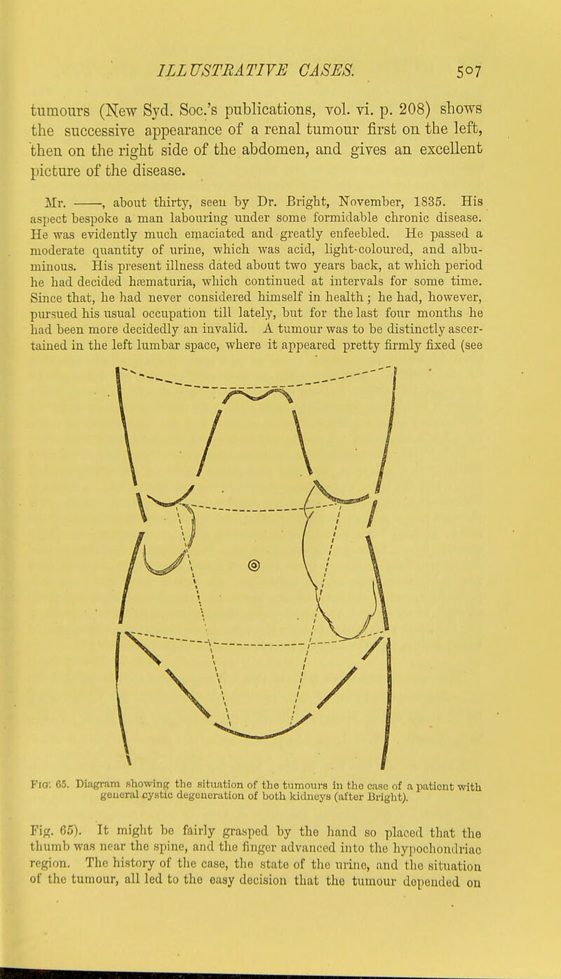 tumours (New Syd. Soc.'s publications, vol. vi. p. 208) shows the successive appearance of a renal tumour first on the left, then on the right side of the abdomen, and gives an excellent picture of the disease. Mr. , about thirty, seeii by Dr. Bright, November, 1835. His aspect bespoke a man labouring under some formidable chronic disease. He was evidently much emaciated and greatly enfeebled. He passed a moderate quantity of urine, which was acid, light-coloured, and albu- minous. His present illness dated about two years back, at which period he had decided hematuria, which continued at intervals for some time. Since that, he had never considered himself in health ; he had, however, pursued his usual occupation till lately, but for the last four months he had been more decidedly an invalid. A tumour was to be distinctly ascer- tained in the left lumbar space, where it appeared pretty firmly fixed (see Fia: 65. Diagram showing the situntion of tho tumours in tho case of a patient with geuoral cystic degeneration of both kidneys (after Bright). Pig. (35). It might be fairly grasped by the hand so placed that the thumb was near the spine, and the finger advanced into the hypochondriac region. The history of the case, tho state of tho urine, and tho situation of the tumour, all led to the easy docision that tho tumour depended on