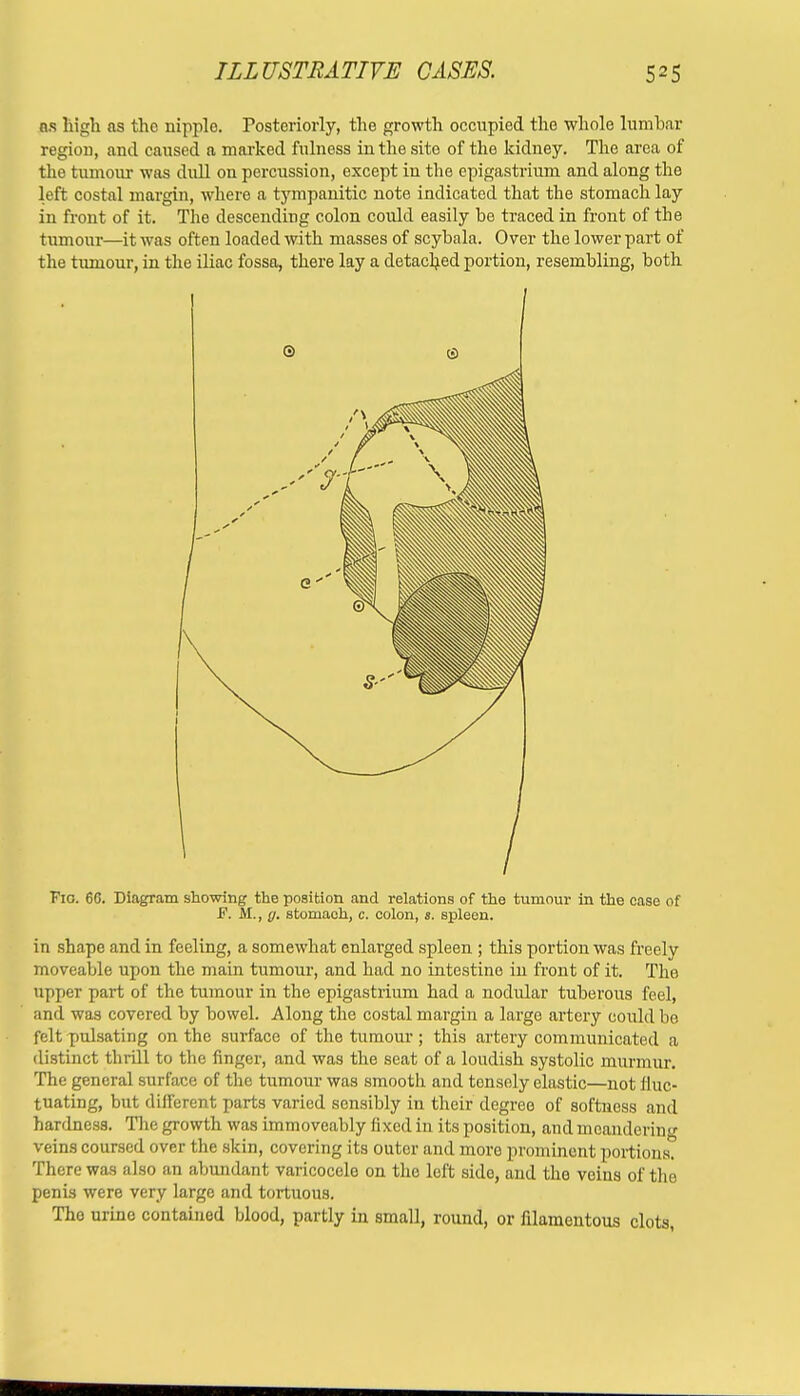 ns high as the nipple. Posteriorly, the growth occupied the whole lumbar region, and caused a marked fulness in the site of the kidney. The area of the tumour was dull on percussion, except in the epigastrium and along the left costal margin, where a tympanitic note indicated that the stomach lay in front of it. The descending colon could easily be traced in front of the tumour—it was often loaded with masses of scybala. Over the lower part of the tumour, in the iliac fossa, there lay a detached portion, resembling, both Fio. 66. Diagram showing the position and relations of the tumour in the case of JF. M., y. stomach, c. colon, s. spleen. in shape and in feeling, a somewhat enlarged spleen ; this portion was freely moveable upon the main tumour, and had no intestine in front of it. The upper part of the tumour in the epigastrium had a nodular tuberous feel, and was covered by bowel. Along the costal margin a large artery could bo felt pulsating on the surface of the tumour ; this artery communicated a distinct thrill to the finger, and was the seat of a loudish systolic murmur. The general surface of the tumour was smootli and tensely elastic—not fluc- tuating, but different parts varied sensibly in their degree of softness and hardness. The growth was immoveably fixed in its position, and meandering veins coursed over the skin, covering its outer and moro prominent portions. There was also an abundant varicocele on the left side, and the veins of the penis were very large and tortuous. Tho urine contained blood, partly in small, round, or filamentous clots,
