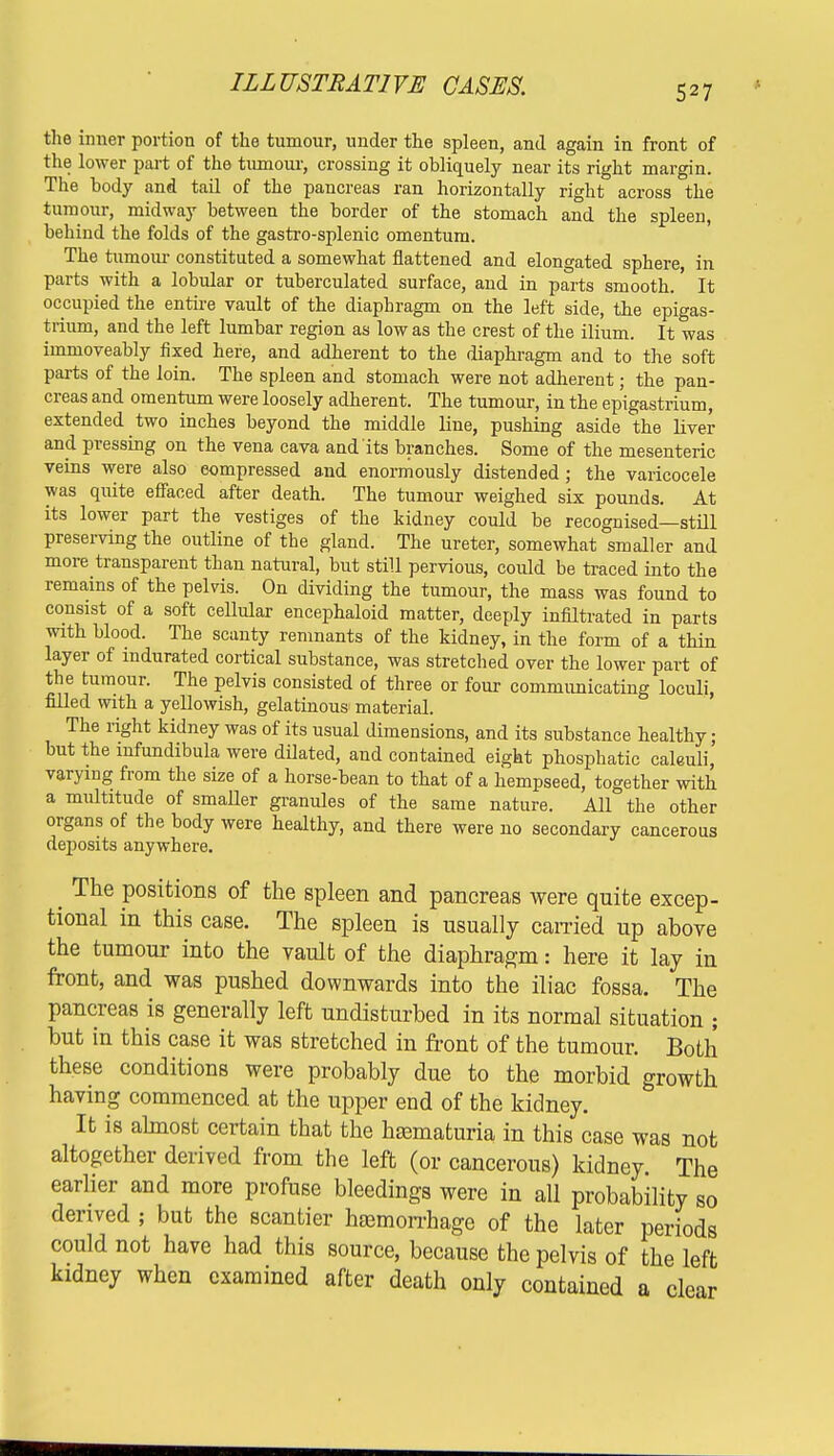 the inner portion of the tumour, under the spleen, and again in front of the lower part of the tumour, crossing it obliquely near its right margin. The body and tail of the pancreas ran horizontally right across the tumour, midway between the border of the stomach and the spleen, behind the folds of the gastro-splenic omentum. The tumour constituted a somewhat flattened and elongated sphere, in parts with a lobular or tuberculated surface, and in parts smooth. It occupied the entire vault of the diaphragm on the left side, the epigas- trium, and the left lumbar region as low as the crest of the ilium. It was iinnioveably fixed here, and adherent to the diaphragm and to the soft parts of the loin. The spleen and stomach were not adherent; the pan- creas and omentum were loosely adherent. The tumour, in the epigastrium, extended two inches beyond the middle line, pushing aside the liver and pressing on the vena cava and its branches. Some of the mesenteric veins were also compressed and enormously distended; the varicocele was quite effaced after death. The tumour weighed six pounds. At its lower part the vestiges of the kidney could be recognised—still preserving the outline of the gland. The ureter, somewhat smaller and more transparent than natural, but still pervious, could be traced into the remains of the pelvis. On dividing the tumour, the mass was found to consist of a soft cellular encephaloid matter, deeply infiltrated in parts with blood. The scanty remnants of the kidney, in the form of a thin layer of indurated cortical substance, was stretched over the lower part of the tumour. The pelvis consisted of three or four communicating loculi, filled with a yellowish, gelatinous material. The right kidney was of its usual dimensions, and its substance healthy; but the mfundibula were dilated, and contained eight phosphatic caleuli, varying from the size of a horse-bean to that of a hempseed, together with a multitude of smaller granules of the same nature. All the other organs of the body were healthy, and there were no secondary cancerous deposits anywhere. ^ The positions of the spleen and pancreas were quite excep- tional in this case. The spleen is usually earned up above the tumour into the vault of the diaphragm: here it lay in front, and was pushed downwards into the iliac fossa. The pancreas is generally left undisturbed in its normal situation ; but in this case it was stretched in front of the tumour. Both these conditions were probably due to the morbid growth having commenced at the upper end of the kidney. It is almost certain that the hematuria in this case was not altogether derived from the left (or cancerous) kidney The earlier and more profuse bleedings were in all probability so derived ; but the scantier haemorrhage of the later periods could not have had this source, because the pelvis of the left kidney when examined after death only contained a clear