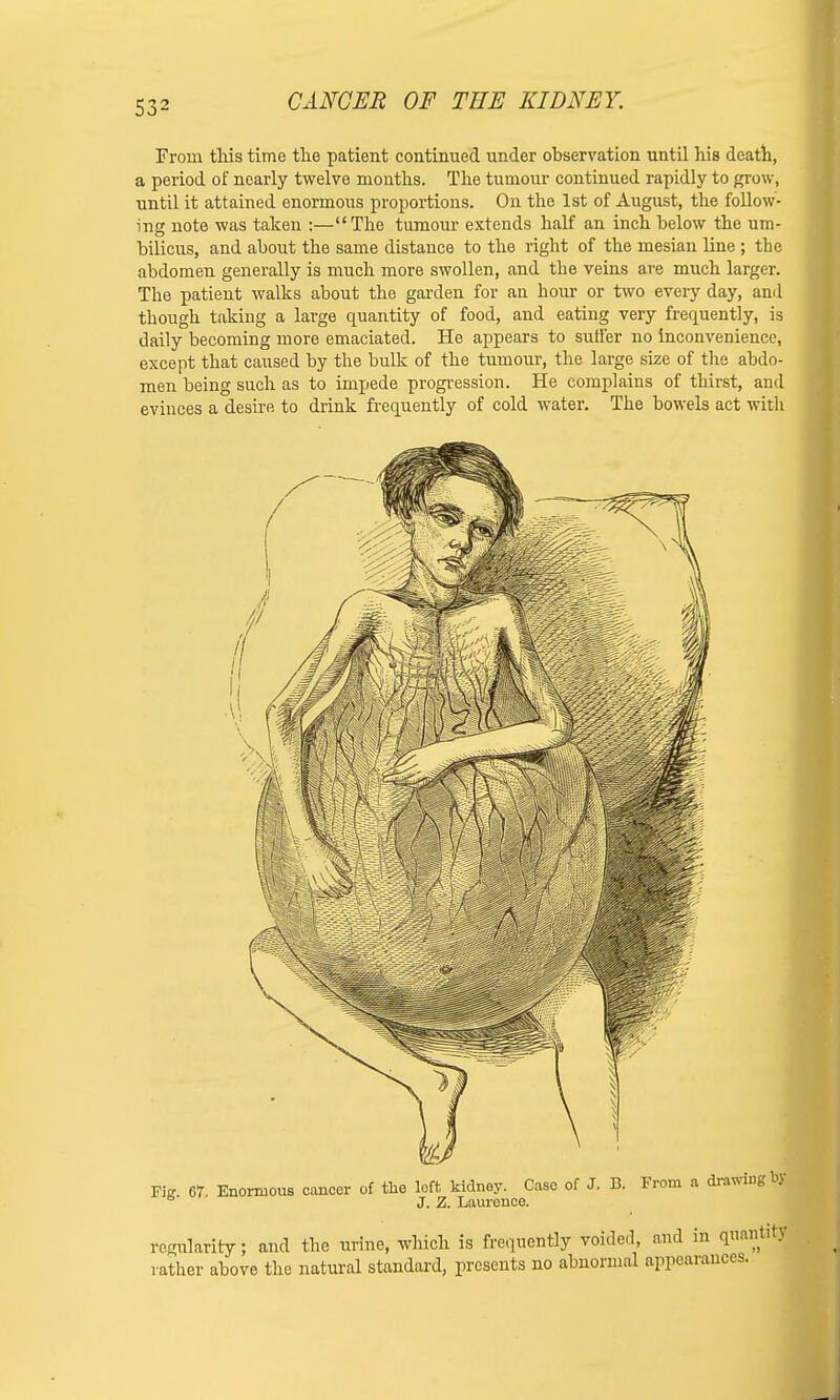 From this time the patient continued under observation until his death, a period of nearly twelve months. The tumour continued rapidly to grow, until it attained enormous proportions. On the 1st of August, the follow- ing note was taken :—The tumour extends half an inch below the um- bilicus, and about the same distance to the right of the mesian line ; the abdomen generally is much more swollen, and the veins are much larger. The patient walks about the garden for an hour or two every day, anil though taking a large quantity of food, and eating very frequently, is daily becoming more emaciated. He appears to suffer no inconvenience, except that caused by the bulk of the tumour, the large size of the abdo- men being such as to impede progression. He complains of thirst, and evinces a desire to drink frequently of cold water. The bowels act with Pig. 67. Enormous cancer of the loft kidney. Case of J. B. From a drawing^ J. Z. Laurence. regularity; and the urine, which is frequently voided, and in quantity rather above the natural standard, presents no abnormal appearances.