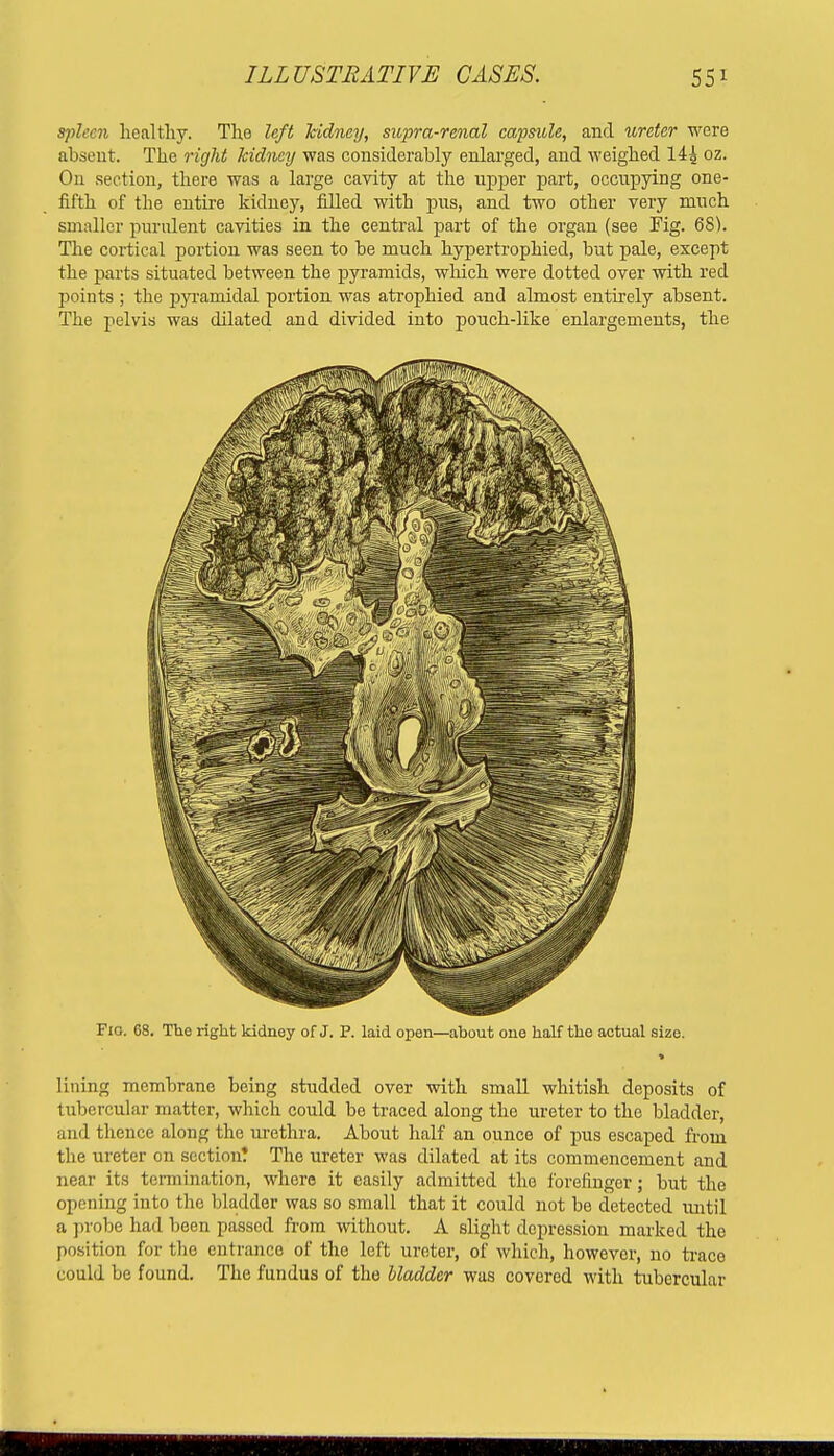 spleen healthy. The left kidney, supra-renal capsule, and ureter were absent. The right kidney was considerably enlarged, and weighed 14| oz. On section, there was a large cavity at the upper part, occupying one- fifth of the entire kidney, filled with pus, and two other very much smaller purulent cavities in the central part of the organ (see Fig. 68). The cortical portion was seen to be much hypertrophied, but pale, except the parts situated between the pyramids, which were dotted over with red points ; the pyramidal portion was atrophied and almost entirely absent. The pelvis was dilated and divided into pouch-like enlargements, the Fig. 68. The right kidney of J. P. laid open—about one half the actual size. lining membrane being studded over with small whitish deposits of tubercular matter, which could be traced along the ureter to the bladder, and thence along the urethra. About half an ounce of pus escaped from the ureter on section! The ureter was dilated at its commencement and near its termination, where it easily admitted the forefinger; but the opening into the bladder was so small that it could not be detected until a probe had been passed from without. A slight depression marked the position for the entrance of the left ureter, of which, however, no trace could be found. The fundus of the bladder was covered with tubercular