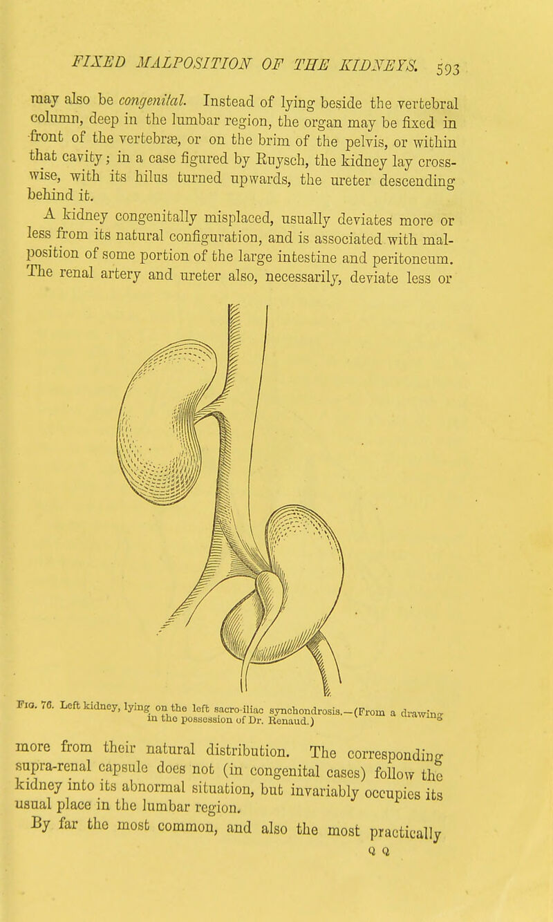 may also be congenital Instead of lying beside the vertebral column, deep in the lumbar region, the organ may be fixed in front of the vertebra, or on the brim of the pelvis, or within that cavity; in a case figured by Kuysch, the kidney lay cross- wise, with its hilus turned upwards, the ureter descending behind it. A kidney congenially misplaced, usually deviates more or less from its natural configuration, and is associated with mal- position of some portion of the large intestine and peritoneum. The renal artery and ureter also, necessarily, deviate less or Via. 70. Left kidney, lying on the left sacro iliac synchondrosis.-(Froni a drawin- in the possession of Dr. Ronaud.)  more from their natural distribution. The corresponding supra-renal capsule does not (in congenital cases) follow the kidney into its abnormal situation, but invariably occupies its usual place in the lumbar region. By far the most common, and also the most practically Q Q