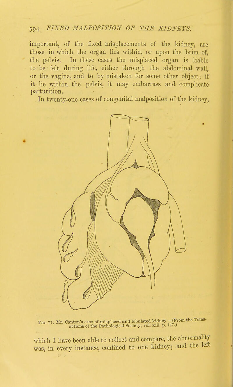 important, of the fixed misplacements of the kidney, are those in which the organ lies within, or upon the brim of, the pelvis. In these cases the misplaced organ is liable to be felt during life, either through the abdominal wall, or the vagina, and to by mistaken for some other object; if it lie within the pelvis, it may embarrass and complicate parturition. In twenty-one cases of congenital malposition of the kidney, Fid 77 Mr Canton's case of misplaced and lobulated kidney.—(From the Trans- actions of the Pathological Society, vol. xiii. p. 14(0 which I have been able to collect and compare, the abnormality was, in every instance, confined to one kidney; and the left