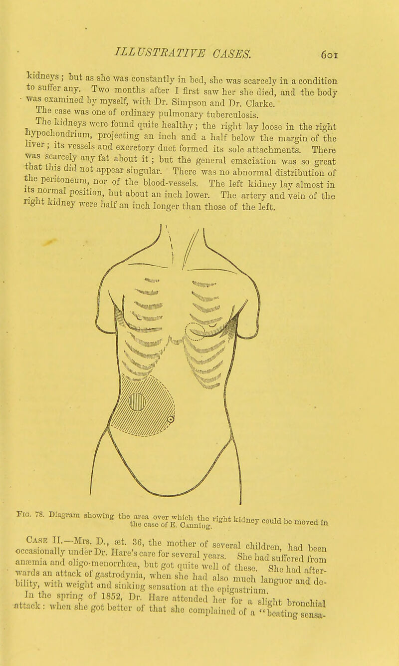 kidneys ; but as she was constantly in bed, she was scarcely in a condition to suffer any. Two months after I first saw her she died, and the body ■ was examined by myself, with Dr. Simpson and Dr. Clarke. The case was one of ordinary pulmonary tuberculosis. The kidneys were found quite healthy; the right lay loose in the right lypochondrnim, projecting an inch and a half below the margin of the iiver • its vessels and excretory duct formed its sole attachments. There was scarcely any fat about it; but the general emaciation was so great that this did not appear singular. There was no abnormal distribution of the peritoneum, nor of the blood-vessels. The left kidney lay almost in its normal position, but about an inch lower. The artery and vein of the right kidney were half an inch longer than those of the left. Case II.-Mrs. D., set. 36, the mother of several children Wl * occasionally under Dr. Hare'scare for several years. She had suffered from aneemia and oligo-menorrho3a, but got quite well of these S*ZLhT w,n.s an attack of g.tr^.ynia, ,h,„, she had also mS lang ^uf t b.Iity, with weight and sinking sensation at the epigastrium Id the spring of 1852, Dr. Hare attended her for a SLt h, i ■ , attack: when she got better of that she co^^J^^