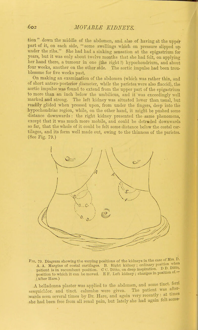 tion  down the middle of the abdomen, and also of having at the upper part of it, on each side, '' some swellings which on pressure slipped up under the ribs. She had had a sinking sensation at the epigastrium for years, but it was only about twelve months that she had felt, on applying her hand there, a tumour in one (the right ?) hypochondrium, and about four weeks, another on the other side. The aortic impulse had been trou- blesome for five weeks past. On making an examination of the abdomen (which was rather thin, and of short antero-posterior diameter, while the parietes were also flaccid), the aortic impulse was found to extend from the upper part of the epigastrium to more than an inch below the umbilicus, and it was exceedingly well marked and strong. The left kidney was situated lower than usual, but readily glided when pressed upon, from under the fingers, deep into the hypochondriac region, while, on the other hand, it might be pushed some distance downwards : the right kidney presented the same phenomena, except that it was much more mobile, and could be detruded downwards so far, that the whole of it could be felt some distance below the costal car- tilages, and its form well made out, owing to the thinness of the parietes. (See Fig. 79.) Pig. 79. Diagram showing the varying positions of tho kidneys in the case of Mrs D. A. A. Margins of costal cartilages. B. Right kidney ; ordinary position wben patient is in recumbent position. C 0. Ditto, on deep inspiration. D D. Vlt ' position to which it can bo moved. B F. Left kidney; changes in position oi. (After Hare.) A belladonna plaster was applied to the abdomen, and some tinct. fern sesquichlor. and tinct. calumbse were given. The patient was nito- wards seen several times by Dr. Hare, and again very recently: at times she had been free from all renal pain, but lately she had again felt some-