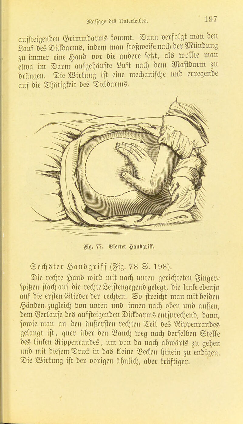aHctffaßc bc§ Untcrtei6c3. auffteigenben ©rimmbormS lommt. Storni Verfolgt man ben Sauf be§ ®icfbarm§, inbem man ftofemeifenacl) ber Sftüubung §u immer eine £anb bor bie anbere fe|tr at§ toottte mau etma im ®arm aufgehäufte Suft nad) beut äRaftbarm jn bräugeu. ®ie SBirhtng ift eine med)anifd)e unb erregenbe auf bie 33}ätigfett be§ ©tcfbarntS. $iß. 77. Werter §ant>ßriff. ©ecpter £anbgriff (gig. 78 ©. 198). ®ie redjte §anb mirb mit nad) unten gerichteten $inger= fpitjen f(ad) auf bie redjte Seiftengegenb gelegt, bie tin!e ebenfo auf bie erften ©lieber ber recfjten. @o ftretdjt man mitbeiben Rauben pgteid) bon unten unb innen nad) oben unb aufjen, bem Verlaufe be§ auffteigenben ®idbarm§ entfpredjenb, bann, fomie man an ben äufjerften redeten Seil be§ 9tippenranbe§ gelangt ift, quer über ben Saud) tueg nad) berfeiben (Steife be§ luden 9tippenranbe§, um bon ba nad) abmärt§ 51t gef)en unb mit biefem ®rud in ba§ Heine Sßecfen tjinein 51t enbigen. ®ie SBtrlung ift ber borigen äfmftd), aber kräftiger.