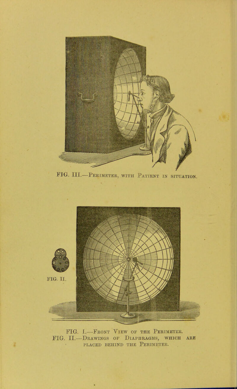 FIG. III.—Perimeter, with Patient in situation. FIG. 1.—Front View of the Perimeter. FIG. II.—Drawings of Diaphragms, which are PLACED behind THE PeRIMETEK.