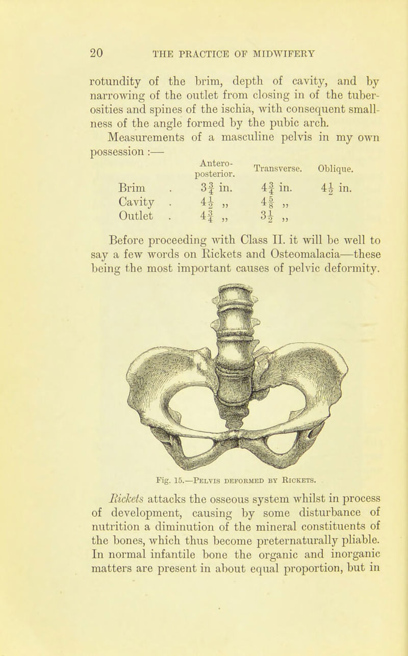 rotundity of the brim, depth of cavity, and by narrowing of the outlet from closing in of the tuber- osities and spines of the ischia, with consecpient small- ness of the angle formed by the pubic arch. Measurements of a masculine pelvis in my own possession :— Antero- m ,. Transverse. Oblique, posterior. 1 Brim . 3f in. 4§ in. 4| in. Cavity . 4J „ 4f „ Outlet . 4f „ 3| „ Before proceeding with Class II. it will be well to say a few words on Rickets and Osteomalacia—these being the most important causes of pelvic deformity. Fig. 15.—Pelvis deformed by Rickets. Rickets attacks the osseous system whilst in process of development, causing by some disturbance of nutrition a diminution of the mineral constituents of the bones, which thus become preternaturally pliable. In normal infantile bone the organic and inorganic matters are present in about equal proportion, but in
