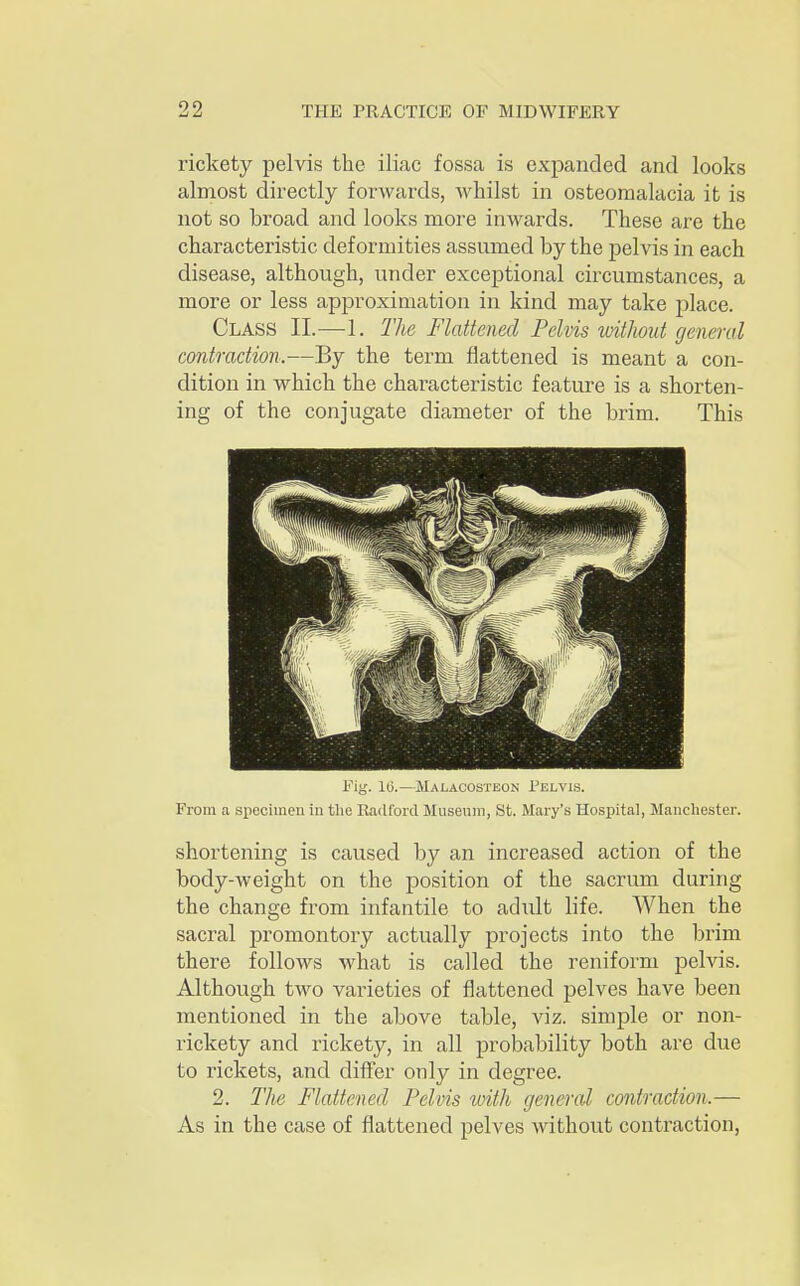 rickety pelvis the iliac fossa is expanded and looks almost directly forwards, whilst in osteomalacia it is not so broad and looks more inwards. These are the characteristic deformities assumed by the pelvis in each disease, although, under exceptional circumstances, a more or less approximation in kind may take place. Class II.—1. The Flattened Pelvis without general contraction.—By the term flattened is meant a con- dition in which the characteristic feature is a shorten- ing of the conjugate diameter of the brim. This Fig. 10.—Malacosteon Pelvis. From a specimen in the Radford Museum, St. Mary's Hospital, Manchester. shortening is caused by an increased action of the body-weight on the position of the sacrum during the change from infantile to achilt life. When the sacral promontory actually projects into the brim there follows what is called the reniform pelvis. Although two varieties of flattened pelves have been mentioned in the above table, viz. simple or non- rickety and rickety, in all probability both are due to rickets, and differ only in degree. 2. The Flattened Pelvis with general contraction.— As in the case of flattened pelves without contraction,