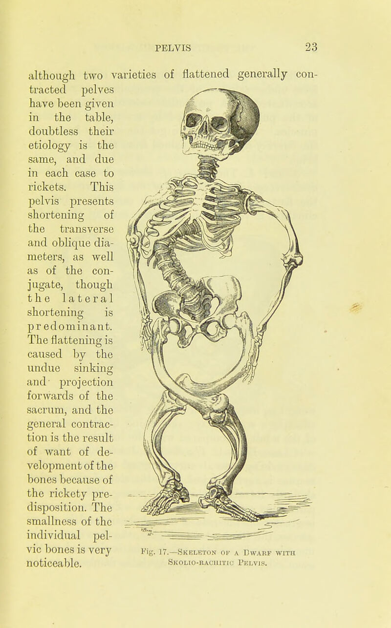 although tracted have been given in the table, doubtless their etiology is the same, and due in each case to rickets. This pelvis presents shortening of the transverse and oblique dia- meters, as well as of the con- jugate, though the lateral shortening is predominant. The flattening is caused by the undue sinking and- projection forwards of the sacrum, and the general contrac- tion is the result of want of de- velopment of the bones because of the rickety pre- disposition. The smallncss of the individual pel- vic bones is very noticeable. two varieties of flattened generally con- pelves Fig. 17.—Skeleton of a Dwarf with Skolio-bachitic Pelvis*