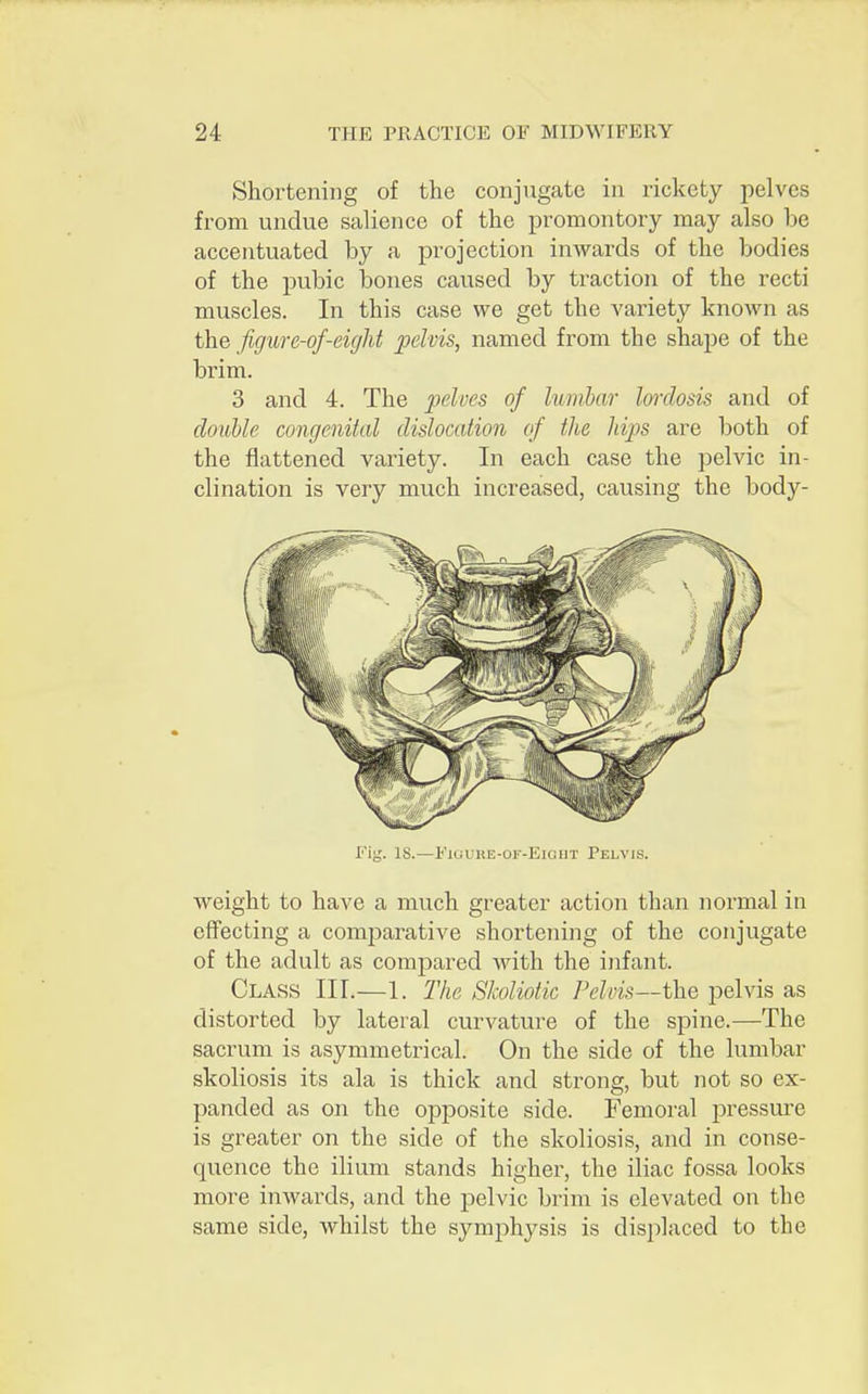 Shortening of the conjugate in rickety pelves from undue salience of the promontory may also be accentuated by a projection inwards of the bodies of the pubic bones caused by traction of the recti muscles. In this case we get the variety known as the figure-of-eight pelvis, named from the shape of the brim. 3 and 4. The pelves of lumbar lordosis and of double congenital dislocation of the hips are both of the flattened variety. In each case the pelvic in- clination is very much increased, causing the body- Fig. IS.—Figure-of-eight Telvis. weight to have a much greater action than normal in effecting a conrparative shortening of the conjugate of the adult as compared with the infant. Class III.—1. The Skoliotic Pelvis—the pelvis as distorted by lateral curvature of the spine.—The sacrum is asymmetrical. On the side of the lumbar skoliosis its ala is thick and strong, but not so ex- panded as on the opposite side. Femoral pressure is greater on the side of the skoliosis, and in conse- quence the ilium stands higher, the iliac fossa looks more inwards, and the pelvic brim is elevated on the same side, whilst the symphysis is displaced to the