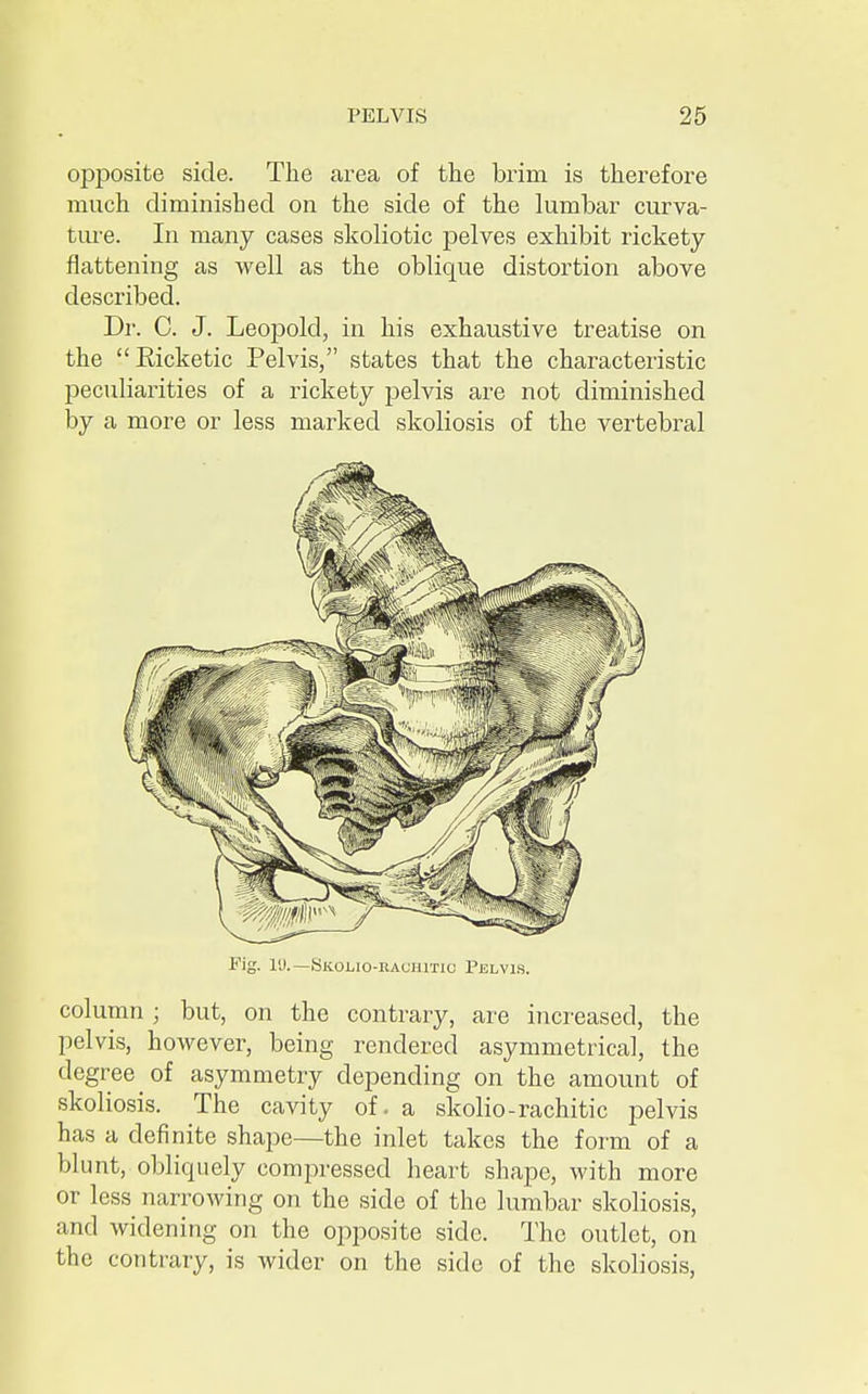 opposite side. The area of the brim is therefore much diminished on the side of the lumbar curva- ture. In many cases skoliotic pelves exhibit rickety flattening as well as the oblique distortion above described. Dr. C. J. Leopold, in his exhaustive treatise on the Ricketic Pelvis, states that the characteristic peculiarities of a rickety pelvis are not diminished by a more or less marked skoliosis of the vertebral Fig. ID.—SKOLio-itAuiimc Pelvis. column ; but, on the contrary, are increased, the pelvis, however, being rendered asymmetrical, the degree of asymmetry depending on the amount of skoliosis. The cavity of - a skolio-rachitic pelvis has a definite shape—the inlet takes the form of a blunt, obliquely compressed heart shape, with more or less narrowing on the side of the lumbar skoliosis, and widening on the opposite side. The outlet, on the contrary, is wider on the side of the skoliosis,