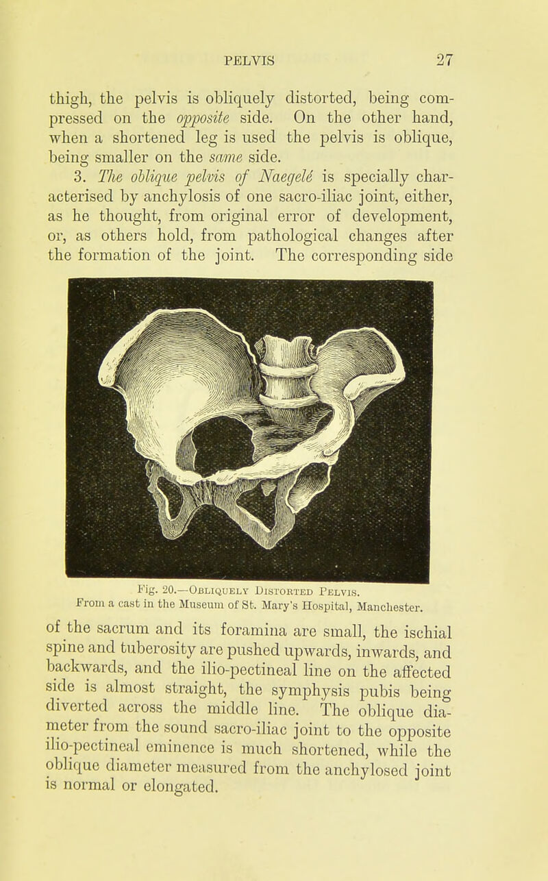 thigh, the pelvis is obliquely distorted, being com- pressed on the opposite side. On the other hand, when a shortened leg is used the pelvis is oblique, being smaller on the same side. 3. The oblique pelvis of NaegeU is specially char- acterised by anchylosis of one sacro-iliac joint, either, as he thought, from original error of development, or, as others hold, from pathological changes after the formation of the joint. The corresponding side Fig. 20.—Obliquely Distobted Pelvis. From a cast in the Museum of St. Mary's Hospital, Manchester. of the sacrum and its foramina are small, the ischial spine and tuberosity are pushed upwards, inwards, and backwards, and the ilio-pectineal line on the affected side is almost straight, the symphysis pubis being diverted across the middle line. The oblique dia- meter from the sound sacro-iliac joint to the opposite Uio-pectineal eminence is much shortened, while the oblique diameter measured from the anchylosed joint is normal or elongated.