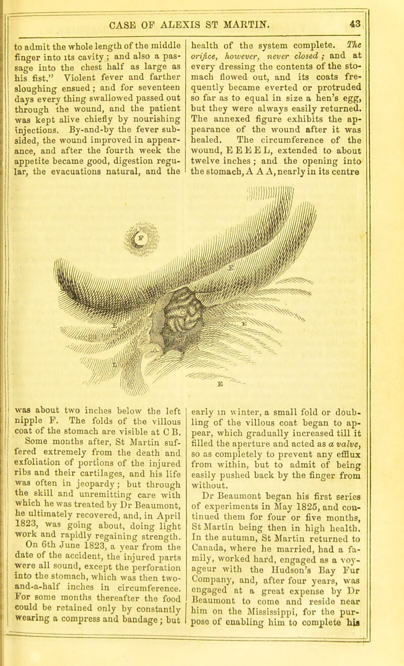 to admit the whole length of the middle finger into its cavity ; and also a pas- sage into the chest half as large as his fist. Violent fever and farther sloughing ensued; and for seventeen days every thing swallowed passed out through the wound, and the patient was kept alive chiefly by nourishing injections. By-and-by the fever sub- sided, the wound improved in appear- ance, and after the fourth week the appetite became good, digestion regu- lar, the evacuations natural, and the health of the system complete. The orifice, however, never closed; and at every dressing the contents of the sto- mach flowed out, and its coats fre- quently became everted or protruded so far as to equal in size a hen's egg, but they were always easily returned. The annexed figure exhibits the ap- pearance of the wound after it was healed. The circumference of the wound, E E E E L, extended to about twelve inches ; and the opening into the stomach, A A A, nearly in its centre was about two inches below the left nipple F. The folds of the villous coat of the stomach are visible at C B. Some months aftei-, St Martin suf- fered extremely from the death and exfoliation of portions of the injured ribs and their cartilages, and his life was often in jeopardy ; but through the^ skill and unremitting care with which he was treated by Dr Beaumont, he ultimately recovered, and, in April 1823, was going about, doing light work and rapidly regaining strength. On 6th June 1823, a year from the date of the accident, the injured parts were all sound, except the perforation into the stomach, which was then two- and-a-half inches in circumference. For some months thereafter the food could be retained only by constantly wearing a compress and bandage; but early in winter, a small fold or doub- ling of the villous coat began to ap- pear, which gradually increased till it filled the aperture and acted as a valve, so as completely to prevent any efiBux from within, but to admit of being easily pushed back by the finger from without. Dr Beaumont began his first series of experiments in May 1825, and con- tinued them for four or five months, St Martin being then in high health. In the autumn, St Martin returned to Canada, where he married, had a fa- mily, worked hard, engaged as a voy- ageur with the Hudson's Bay Fur Company, and, after four years, was engaged at a great expense by Dr Beaumont to come and reside near him on the Mississippi, for the pur- pose of enabling him to complete his