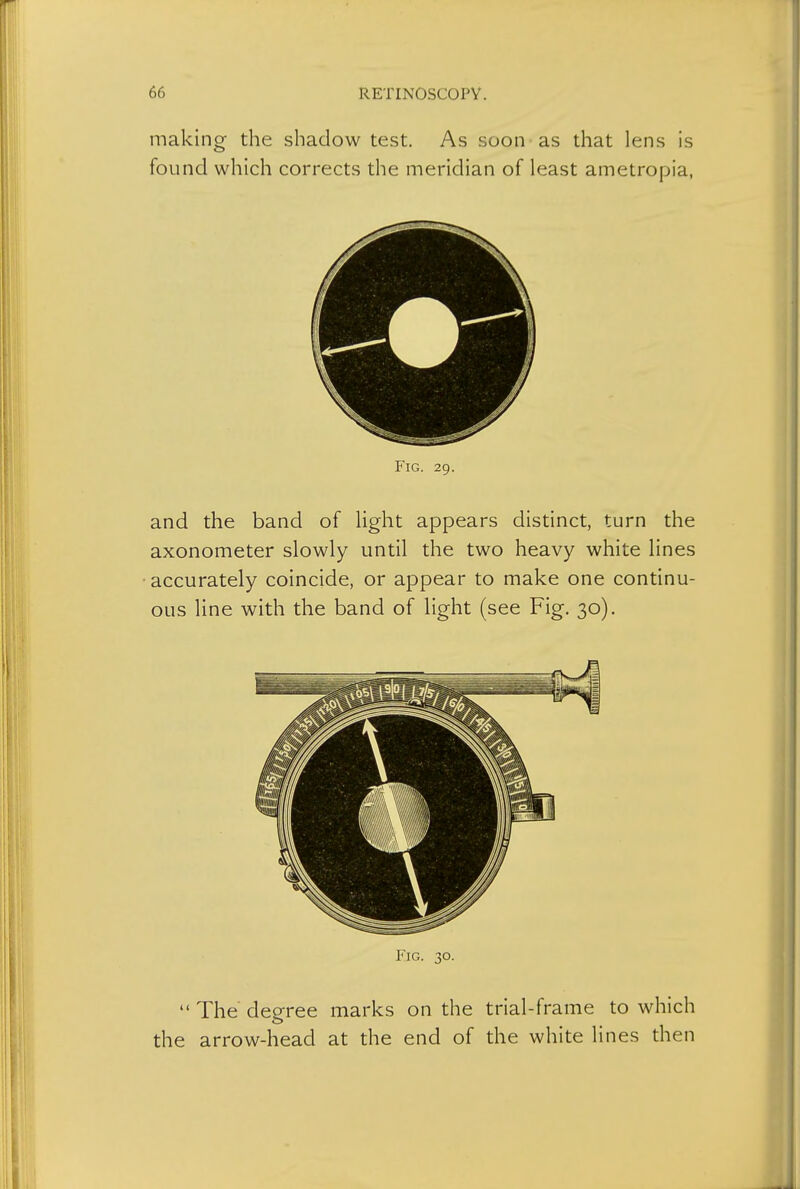 making the shadow test. As soon as that lens is found which corrects the meridian of least ametropia, Fig. 29. and the band of light appears distinct, turn the axonometer slowly until the two heavy white lines accurately coincide, or appear to make one continu- ous line with the band of light (see Fig. 30). Fig. 30.  The degree marks on the trial-frame to which the arrow-head at the end of the white lines then