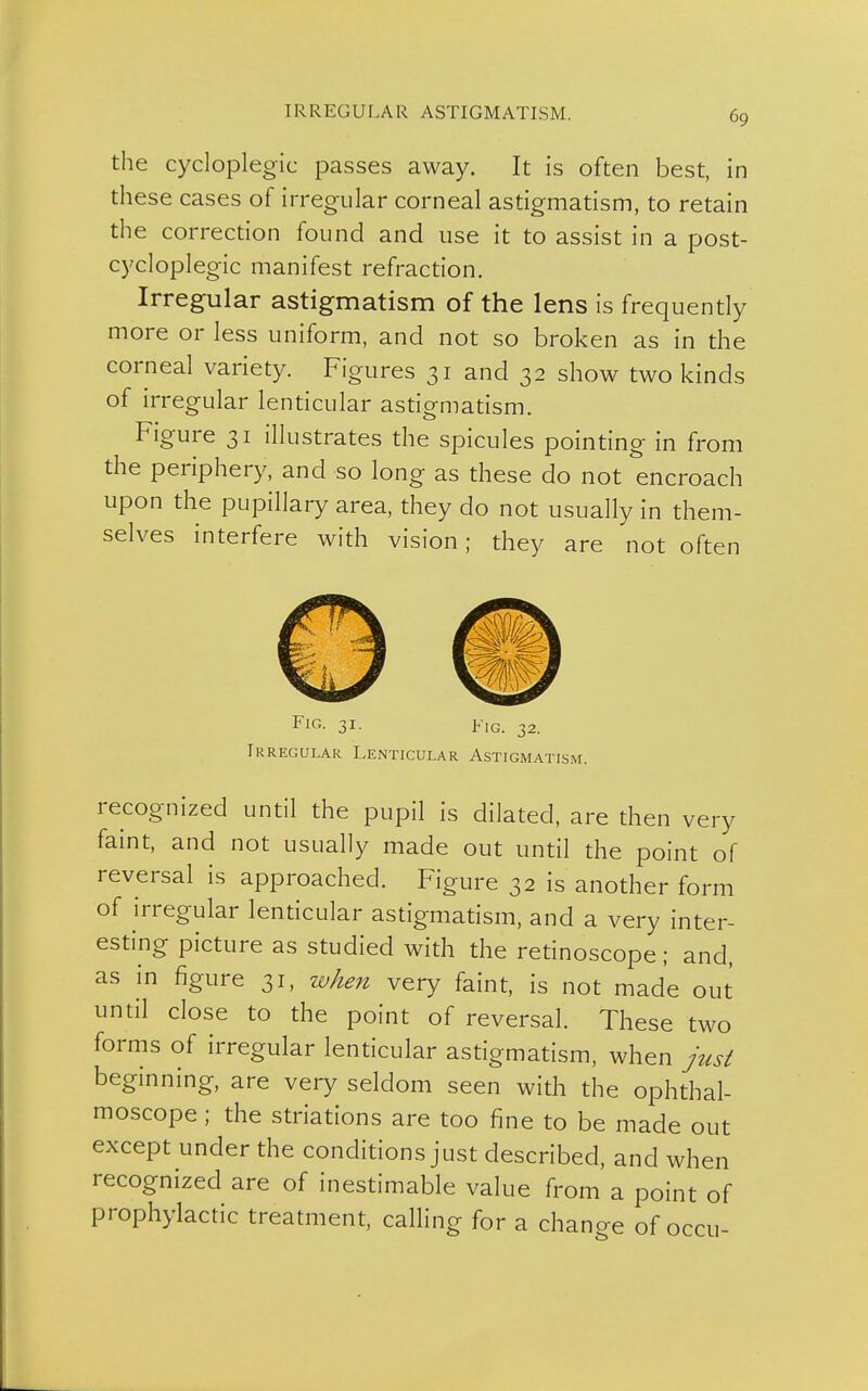 the cycloplegic passes away. It is often best, in these cases of irregular corneal astigmatism, to retain the correction found and use it to assist in a post- cycloplegic manifest refraction. Irregular astigmatism of the lens is frequently more or less uniform, and not so broken as in the corneal variety. Figures 31 and 32 show two kinds of irregular lenticular astigmatism. Figure 31 illustrates the spicules pointing in from the periphery, and so long as these do not encroach upon the pupillary area, they do not usually in them- selves interfere with vision; they are not often Fl(5. 31. Fig. 32. Irregular Lenticular Astigmatism. recognized until the pupil is dilated, are then very faint, and not usually made out until the point of reversal is approached. Figure 32 is another form of irregular lenticular astigmatism, and a very inter- esting picture as studied with the retinoscope; and, as in figure 31, when very faint, is not made out until close to the point of reversal. These two forms of irregular lenticular astigmatism, when just beginning, are very seldom seen with the ophthal- moscope ; the striations are too fine to be made out except under the conditions just described, and when recognized are of inestimable value from a point of prophylactic treatment, calling for a change of occu-