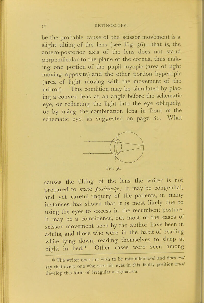 be the probable cause of the scissor movement is a slight tilting of the lens (see Fig. 36)—that is, the antero-posterior axis of the lens does not stand perpendicular to the plane of the cornea, thus mak- ing one portion of the pupil myopic (area ot light moving opposite) and the other portion hyperopic (area of light moving with the movement of the mirror). This condition may be simulated by plac- ing a convex lens at an angle before the schematic eye, or reflecting the light into the eye obliquely, or by using the combination lens in front of the schematic eye, as suggested on page 81. What Fig. 36. causes the tilting of the lens the writer is not prepared to state positively; it maybe congenital, and yet careful inquiry of the patients, in many instances, has shown that it is most likely due to using the eyes to excess in the recumbent posture. It may be a coincidence, but most of the cases of scissor movement seen by the author have been in adults, and those who were in the habit of reading while lying down, reading themselves to sleep at night in bed.* Other cases were seen among * The writer does not wish to be misunderstood and does not say that every one who uses his eyes in this faulty position must develop this form of irregular astigmatism.