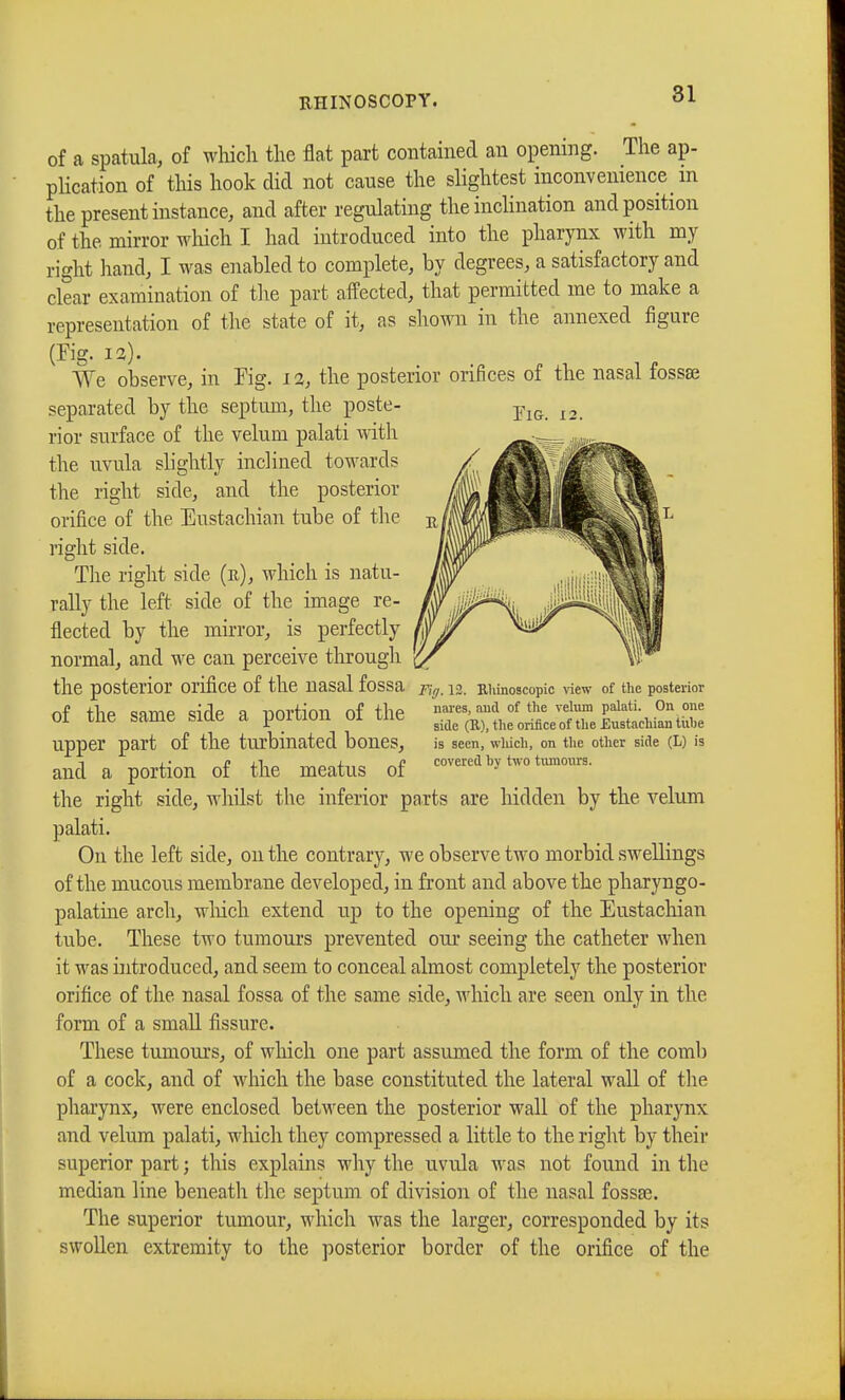 I IG. 12. of a spatula, of which the flat part contained an opening. The ap- plication of this hook did not cause the slightest inconvenience m the present instance, and after regulating the inclination and position of the mirror which I had introduced into the pharynx with my right hand, I was enabled to complete, by degrees, a satisfactory and clear examination of the part affected, that permitted me to make a representation of the state of it, as shown in the annexed figure (Fig. 12). We observe, in Fig. 1 %, the posterior orifices of the nasal fossae separated by the septum, the poste- rior surface of the velum palati with the uvula slightly inclined towards the right side, and the posterior orifice of the Eustachian tube of the right side. The right side (e), which is natu- rally the left side of the image re- flected by the mirror, is perfectly normal, and we can perceive through the posterior Orifice of the nasal fossa jfy. 12. Khinoscopic view of the posterior nf flip samp m'dp a nortl'on of the nares, and of the velum palati. On one 01 me same siae a poiuon 01 me side (R)jt]ieorificeoftue£ustachiantiihe Upper part Of the turbinated bones, is seen, wliich, on the other side (L) is and a portion of the meatus of ™aby two tumours. the right side, whilst the inferior parts are liidden by the velum palati. On the left side, on the contrary, we observe two morbid swellings of the mucous membrane developed, in front and above the pharyngo- palatine arch, which extend up to the opening of the Eustachian tube. These two tumours prevented our seeing the catheter when it was introduced, and seem to conceal almost completely the posterior orifice of the nasal fossa of the same side, which are seen only in the form of a small fissure. These tumours, of which one part assumed the form of the comb of a cock, and of which the base constituted the lateral wall of the pharynx, were enclosed between the posterior wall of the pharynx and velum palati, which they compressed a little to the right by their superior part ; this explains why the uvula was not found in the median line beneath the septum of division of the nasal fossae. The superior tumour, which was the larger, corresponded by its swollen extremity to the posterior border of the orifice of the