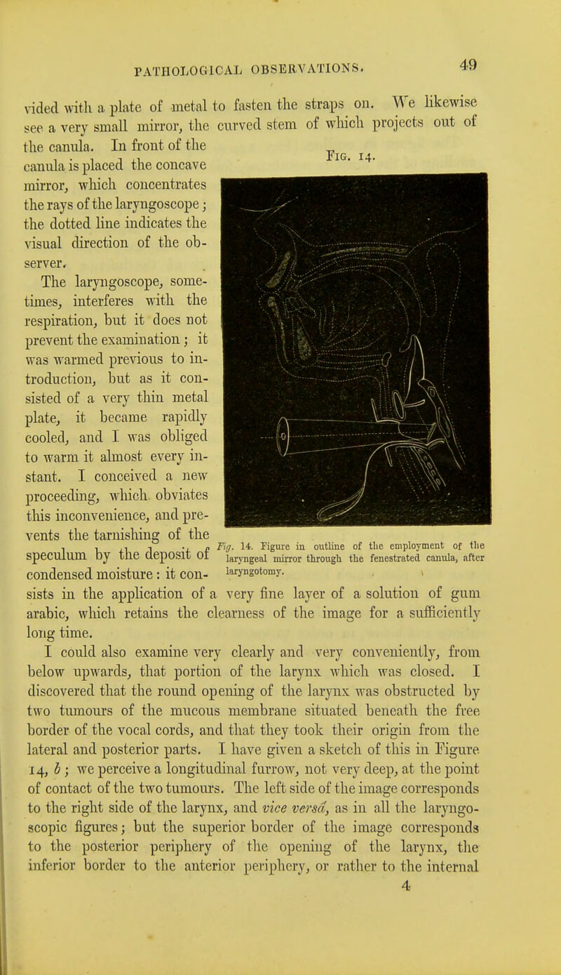 Fig. 14. vided with a plate of metal to fasten the straps on. We likewise see a very small mirror, the curved stem of which projects out of the canula. In front of the canula is placed the concave mirror, which concentrates the rays of the laryngoscope ; the dotted line indicates the visual direction of the ob- server. The laryngoscope, some- times, interferes with the respiration, but it does not prevent the examination ; it was warmed previous to in- troduction, but as it con- sisted of a very thin metal plate, it became rapidly cooled, and I was obliged to warm it almost every in- stant. I conceived a new proceeding, winch obviates this inconvenience, and pre- vents the tarnishing of the , , ,■■ n n Fig. 14. Figure in outline of the employment of the speculum by tile deposit OI laryngeal mirror through the fenestrated canula, after condensed moisture : it con- iwyngotomy. sists in the application of a very fine layer of a solution of gum arabic, which retains the clearness of the image for a sufncienllv long time. I could also examine very clearly and very conveniently, from below upwards, that portion of the larynx which was closed. I discovered that the round opening of the larynx was obstructed by two tumours of the mucous membrane situated beneath the free border of the vocal cords, and that they took their origin from the lateral and posterior parts. I have given a sketch of this in Figure 14, b ; we perceive a longitudinal furrow, not very deep, at the point of contact of the two tumours. The left side of the image corresponds to the right side of the larynx, and vice versa, as in all the laryngo- scopic figures ; but the superior border of the image corresponds to the posterior periphery of the opening of the larynx, the inferior border to the anterior periphery, or rather to the internal 4