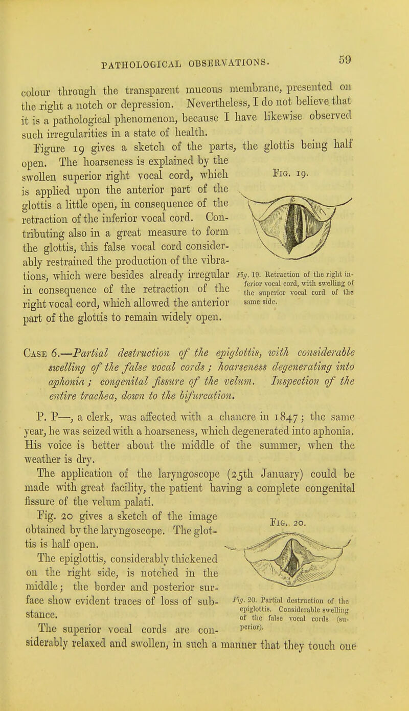 Fig. 19. colour through the transparent mucous membrane, presented on the right a notch or depression. Nevertheless, I do not believe, that it is a pathological phenomenon, because I have likewise observed such irregularities in a state of health. Figure 19 gives a sketch of the parts, the glottis being half open. The hoarseness is explained by the swollen superior right vocal cord, which is applied upon the anterior part of the glottis a little open, in consequence of the retraction of the inferior vocal cord. Con- tributing also in a great measure to form the glottis, this false vocal cord consider- ably restrained the production of the vibra- tions, which were besides already irregular in consequence of the retraction of the right vocal cord, which allowed the anterior part of the glottis to remain widely open. Fit/. 19. Retraction of the right in- ferior vocal cord, with swelling of the superior vocal cord of the same side. Case 6.—Partial destruction of the epiglottis, with considerable swelling of the false vocal cords ; hoarseness degenerating into aphonia ; congenital fissure of the velum. Inspection of the entire trachea, down to the bifurcation. P. P—, a clerk, was affected with a chancre in 1847; the same year, he was seized with a hoarseness, which degenerated into aphonia. His voice is better about the middle of the summer, when the weather is dry. The application of the laryngoscope (25th January) could be made with great facility, the patient having a complete congenital fissure of the velum palati. Pig. 20 gives a sketch of the image obtained by the laryngoscope. The glot- tis is half open. The epiglottis, considerably thickened on the right side, is notched in the middle; the border and posterior sur- face show evident traces of loss of sub- stance. The superior vocal cords are con- siderably relaxed and swollen, in such a manner that they touch one FlGi 20. Fiff. 20. Partial destruction of the epiglottis. Considerable swelling of the false vocal cords (su- perior).