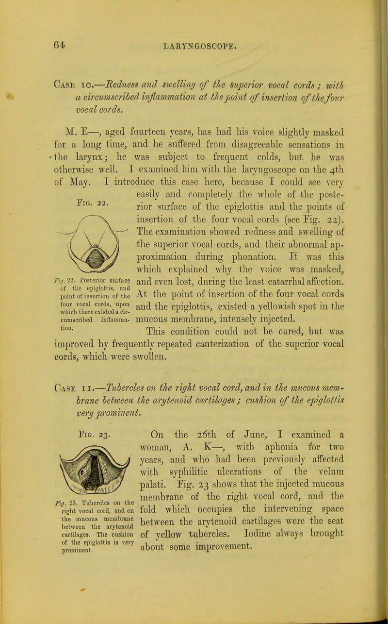 Case io.—Redness and swelling of the superior vocal cords ; with a circumscribed inflammation at the point of insertion qfthefovr vocal cords. M. E—, aged fourteen years, has had his voice slightly masked for a long time, and he suffered from disagreeable sensations in ■the larynx; he was subject to frequent colds, but he Mas otherwise well. I examined him with the laryngoscope on the 4th of May. I introduce this case here, because I could see very easily and completely the whole of the poste- Fig. 22. r-01. surface 0f |]ie epiglottis and the points of insertion of the four vocal cords (see Kg. 22). The examination showed redness and swelling of the superior vocal cords, and their abnormal ap- proximation during phonation. It was this which explained why the voice was masked, riff. 22. Posterior surface anc| even lost, during the least catarrhal affection. of the epiglottis, and . . „ . . „ . . . , point of insertion of the At the point ot insertion or the tour vocal cords four vocal cords upon an£i flie epiglottis, existed a yellowish spot in the which there existed a cir- 1 D ' . . . , , cumscribcd inflamma- mucous membrane, intensely injected. Tins condition could not be cured, but was improved by frequently repeated cauterization of the superior vocal cords, which were swollen. Case i i.—Tubercles on the right vocal cord, and in the mucous mem- brane between the arytenoid cartilages ; cushion of the epiglottis very prominent. Fig. 23. On the 26th of June, I examined a woman, A. K—, with aphonia for two years, and who had been previously affected with syphilitic ulcerations of the velum palati. Tig. 23 shows that the injected mucous membrane of the rieht vocal cord, and the Fig. 23. Tubercles on the . ° right vocal cord, and on fold which occupies the intervening space the mucous membrane |jetween the arytenoid cartilages were the seat between the arytenoid J D cartilages. The cushion of yellow tubercles. Iodine always brought liZS?* U VCVy «bout some improvement.