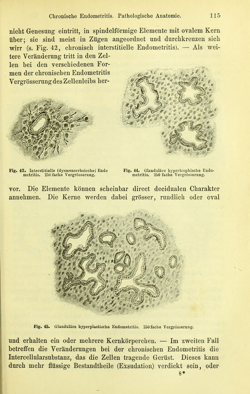 nicht Genesung eintritt, in spindelförmige Elemente mit ovalem Kern über; sie sind meist in Zügen angeordnet und durchkreuzen sich wirr (s. Fig. 42, chronisch interstitielle Endometritis). — Als wei- tere Veränderung tritt in den Zel- len bei den verschiedenen For- men der chronischen Endometritis Vergrösserungdes Zellenleibs her- * - M Fig. 43. Interstitielle (dysmenorrhoische) Endo metritis. 25U fache Vergrösserung. Fig. 44. Glanduläre hypertrophische Endo- metritis. 250 fache Vergrösserung. vor. Die Elemente können scheinbar direct decidualen Charakter annehmen. Die Kerne werden dabei grösser, rundlich oder oval Fig. 45. Glanduläre hyperplastische Endometritis. 250 fache Vergrösserung. und erhalten ein oder mehrere Kernkörperchen. — Im zweiten Fall betreffen die Veränderungen bei der chronischen Endometritis die Intercellularsubstanz, das die Zellen tragende Gerüst. Dieses kann durch mehr flüssige Bestandtheile (Exsudation) verdickt sein, oder 8*