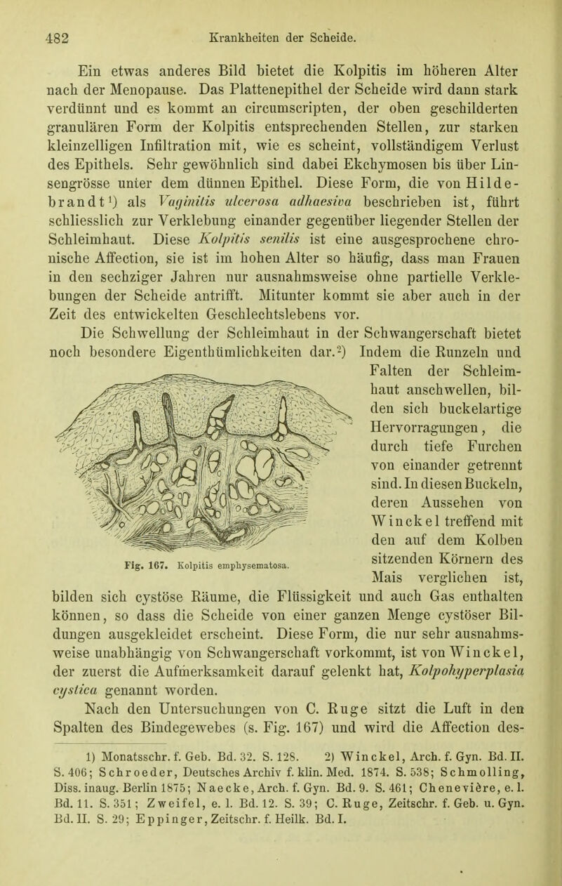 Ein etwas anderes Bild bietet die Kolpitis im höheren Alter nach der Menopause. Das Plattenepithel der Scheide wird dann stark verdünnt und es kommt an circumscripten, der oben geschilderten granulären Form der Kolpitis entsprechenden Stellen, zur starken kleinzelligen Infiltration mit, wie es scheint, vollständigem Verlust des Epithels. Sehr gewöhnlich sind dabei Ekchymosen bis über Lin- sengrösse unter dem dünnen Epithel. Diese Form, die von Hilde- b ran dt1) als Vaginitis ulcerosa adhaesiva beschrieben ist, führt schliesslich zur Verklebung einander gegenüber liegender Stellen der Schleimhaut. Diese Kolpitis senilis ist eine ausgesprochene chro- nische Affection, sie ist im hohen Alter so häufig, dass man Frauen in den sechziger Jahren nur ausnahmsweise ohne partielle Verkle- bungen der Scheide antrifft. Mitunter kommt sie aber auch in der Zeit des entwickelten Geschlechtslebens vor. Die Schwellung der Schleimhaut in der Schwangerschaft bietet noch besondere Eigentümlichkeiten dar.2) Indem die Runzeln und Falten der Schleim- haut anschwellen, bil- den sich buckelartige Hervorragungen, die durch tiefe Furchen von einander getrennt sind. In diesen Buckeln, deren Aussehen von Winckel treffend mit den auf dem Kolben sitzenden Körnern des Mais verglichen ist, bilden sich cystöse Räume, die Flüssigkeit und auch Gas enthalten können, so dass die Scheide von einer ganzen Menge cystöser Bil- dungen ausgekleidet erscheint. Diese Form, die nur sehr ausnahms- weise unabhängig von Schwangerschaft vorkommt, ist von Winckel, der zuerst die Aufmerksamkeit darauf gelenkt hat, Kolpohyperplasia cysticu genannt worden. Nach den Untersuchungen von C. Rüge sitzt die Luft in den Spalten des Bindegewebes (s. Fig. 167) und wird die Affection des- 1) Monatsschr. f. Geb. Bd. 32. S. 128. 2) Winckel, Arch. f. Gyn. Bd. II. S. 406; Sehr oeder, Deutsches Archiv f. Hin. Med. 1874. S. 538; Schmolling, Diss. inaug. Berlin 1875; Naecke, Arch. f. Gyn. Bd. 9. S.461; Cheneviöre, e. 1. Bd. 11. S. 351; Zweifel, e. 1. Bd. 12. S. 39; C. Rüge, Zeitschr. f. Geb. u. Gyn. Bd. II. S. 29; Eppinger, Zeitschr. f. Heilk. Bd. I. Fig. 167. Kolpitis emphysematosa.