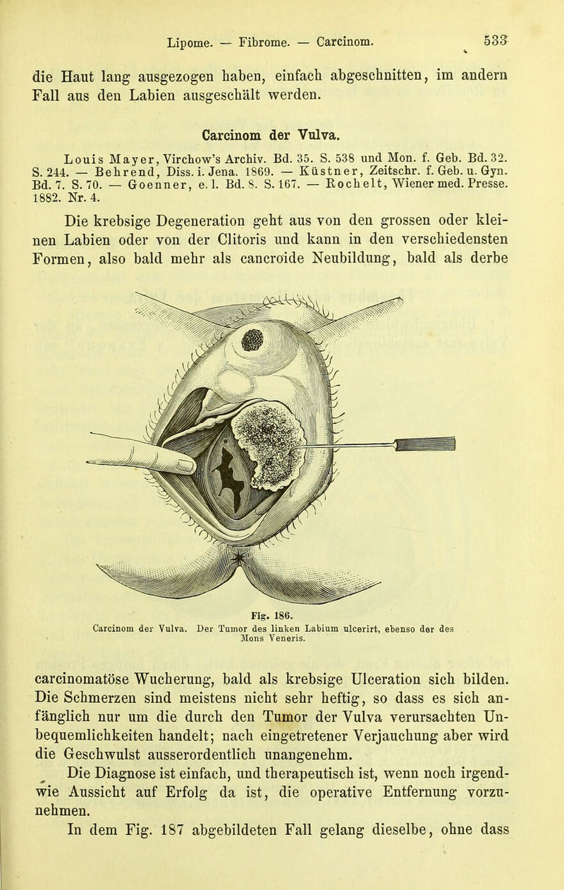 die Haut lang ausgezogen haben, einfach abgeschnitten, im andern Fall aus den Labien ausgeschält werden. Carcinom der Vulva. Louis Mayer, Virchow's Archiv. Bd. 35. S. 538 und Mon. f. Geb. Bd. 32. S. 244. — Behrend, Diss. i. Jena. 1869. — Küstner, Zeitschr. f. Geb. u. Gyn. Bd. 7. S. 70. — Goenner, e. 1. Bd. 8. S. 167. — Roch elt, Wiener med. Presse. 1882. Nr. 4. Die krebsige Degeneration geht aus von den grossen oder klei- nen Labien oder von der Clitoris und kann in den verschiedensten Formen, also bald mehr als cancroide Neubildung, bald als derbe Fig. 186. Carcinom der Vulva. Der Tumor des linken Labium ulcerirt, ebenso der des Möns Veneris. carcinomatöse Wucherung, bald als krebsige Ulceration sich bilden. Die Schmerzen sind meistens nicht sehr heftig, so dass es sich an- fänglich nur um die durch den Tumor der Vulva verursachten Un- bequemlichkeiten handelt; nach eingetretener Verjauchung aber wird die Geschwulst ausserordentlich unangenehm. Die Diagnose ist einfach, und therapeutisch ist, wenn noch irgend- wie Aussicht auf Erfolg da ist, die operative Entfernung vorzu- nehmen. In dem Fig. 187 abgebildeten Fall gelang dieselbe, ohne dass