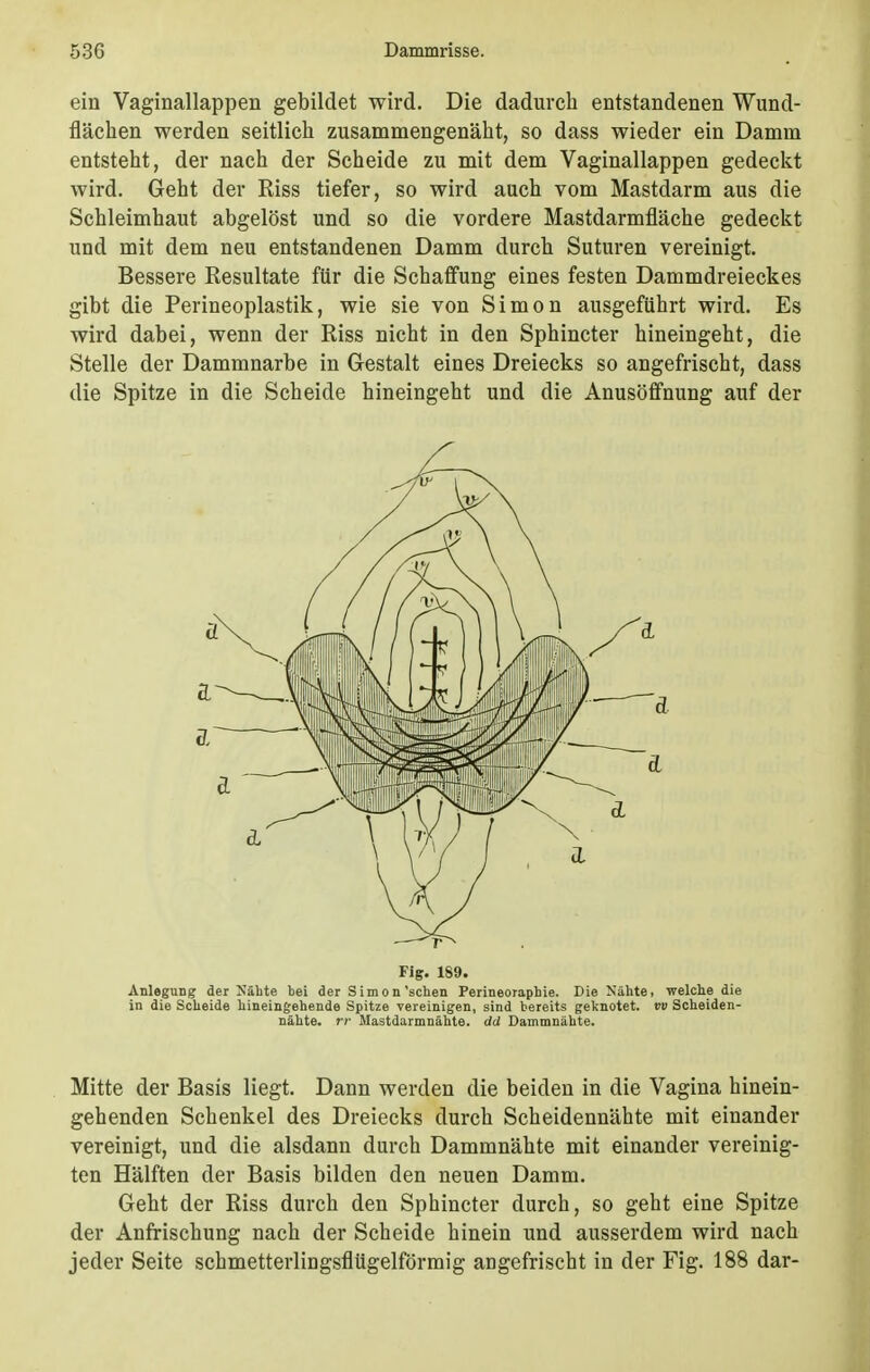 ein Vaginallappen gebildet wird. Die dadurch entstandenen Wund- flächen werden seitlich zusammengenäht, so dass wieder ein Damm entsteht, der nach der Scheide zu mit dem Vaginallappen gedeckt wird. Geht der Riss tiefer, so wird auch vom Mastdarm aus die Schleimhaut abgelöst und so die vordere Mastdarmfläche gedeckt und mit dem neu entstandenen Damm durch Suturen vereinigt. Bessere Resultate für die Schaffung eines festen Dammdreieckes gibt die Perineoplastik, wie sie von Simon ausgeführt wird. Es wird dabei, wenn der Riss nicht in den Sphincter hineingeht, die Stelle der Dammnarbe in Gestalt eines Dreiecks so angefrischt, dass die Spitze in die Scheide hineingeht und die Anusöffnung auf der Mitte der Basis liegt. Dann werden die beiden in die Vagina hinein- gehenden Schenkel des Dreiecks durch Scheidennähte mit einander vereinigt, und die alsdann durch Dammnähte mit einander vereinig- ten Hälften der Basis bilden den neuen Damm. Geht der Riss durch den Sphincter durch, so geht eine Spitze der Anfrischung nach der Scheide hinein und ausserdem wird nach jeder Seite schmetterliDgsflügelförmig angefrischt in der Fig. 188 dar- ä ä