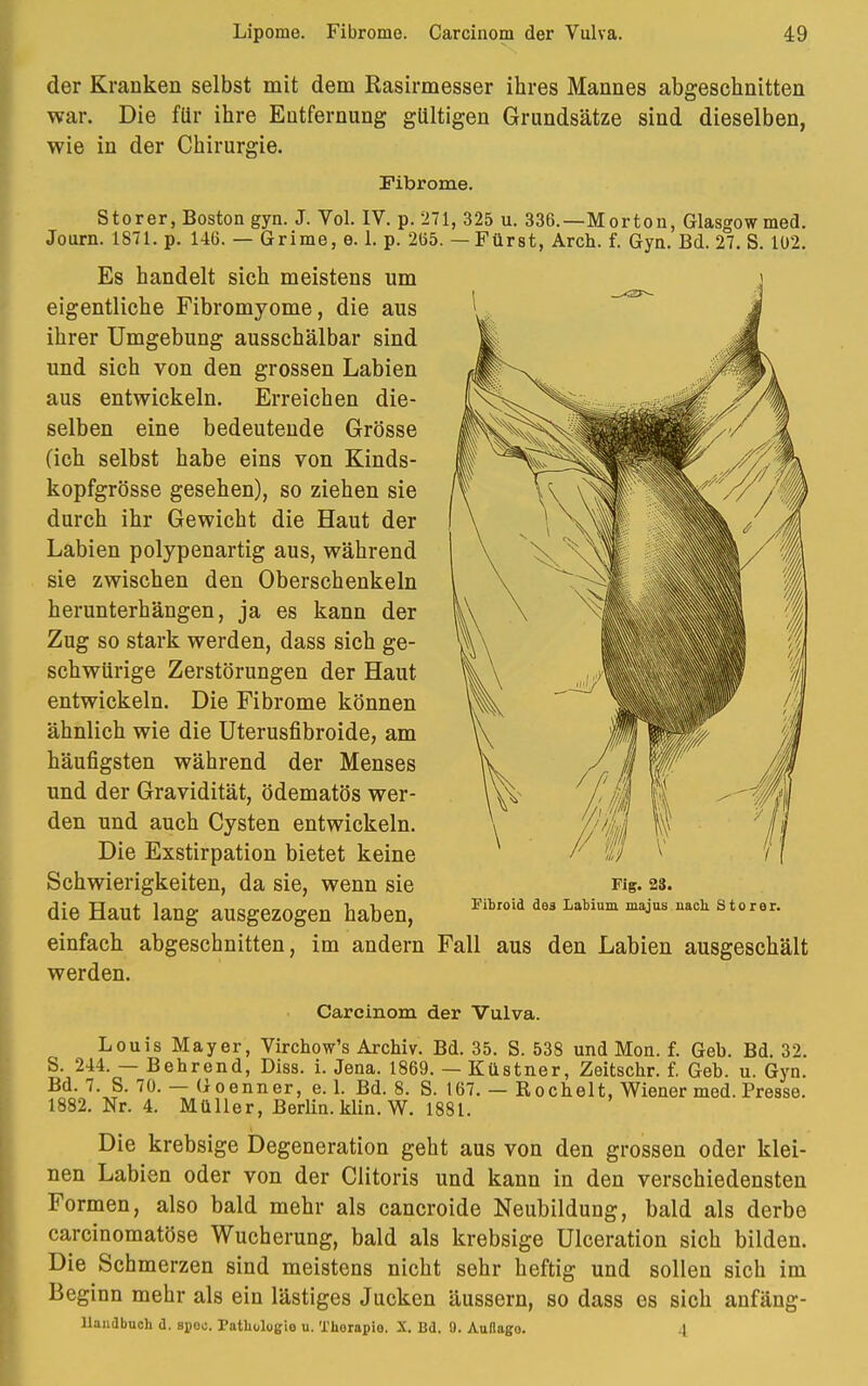 der Kranken selbst mit dem Rasirmesser ihres Mannes abgeschnitten war. Die für ihre Entfernung gültigen Grundsätze sind dieselben, wie in der Chirurgie. Fibrome. Storer, Boston gyn. J. Vol. IV. p. 271, 325 u. 336.—Morton, Glasgow med. Journ. 1871. p. 146. — Grime, e. 1. p. 265. — Fürst, Aren. f. Gyn. Bd. 27. S. 102. Es handelt sich meistens um eigentliche Fibromyome, die aus ihrer Umgebung ausschälbar sind und sich von den grossen Labien aus entwickeln. Erreichen die- selben eine bedeutende Grösse (ich selbst habe eins von Kinds- kopfgrösse gesehen), so ziehen sie durch ihr Gewicht die Haut der Labien polypenartig aus, während sie zwischen den Oberschenkeln herunterhängen, ja es kann der Zug so stark werden, dass sich ge- schwürige Zerstörungen der Haut entwickeln. Die Fibrome können ähnlich wie die Uterusfibroide, am häufigsten während der Menses und der Gravidität, ödematös wer- den und auch Cysten entwickeln. Die Exstirpation bietet keine Schwierigkeiten, da sie, wenn sie die Haut lang ausgezogen haben, einfach abgeschnitten, im andern Fall aus den Labien ausgeschält werden. Carcinom der Vulva. Louis Mayer, Virchow's Archiv. Bd. 35. S. 538 und Mon. f. Geb. Bd. 32. S. 244. — Behrend, Diss. i. Jena. 1869. — Küstner, Zeitschr. f. Geb. u. Gyn. Bd. 7. S. 70. — Goenner, e. 1. Bd. 8. S. 167. — Rochelt, Wiener med. Presse. 1882. Nr. 4. Müller, Berlin, klin. W. 1881. Die krebsige Degeneration geht aus von den grossen oder klei- nen Labien oder von der Clitoris und kann in den verschiedensten Formen, also bald mehr als cancroide Neubildung, bald als derbe carcinomatöse Wucherung, bald als krebsige Ulceration sich bilden. Die Schmerzen sind meistens nicht sehr heftig und sollen sich im Beginn mehr als ein lästiges Jucken äussern, so dass es sich anfäng- llandbuch d. spoo. Pathologie u. Thorapio. X. Bd. 0. Auflago. 4 Fig. 23. Fibroid des Labium majus nach. Storer.