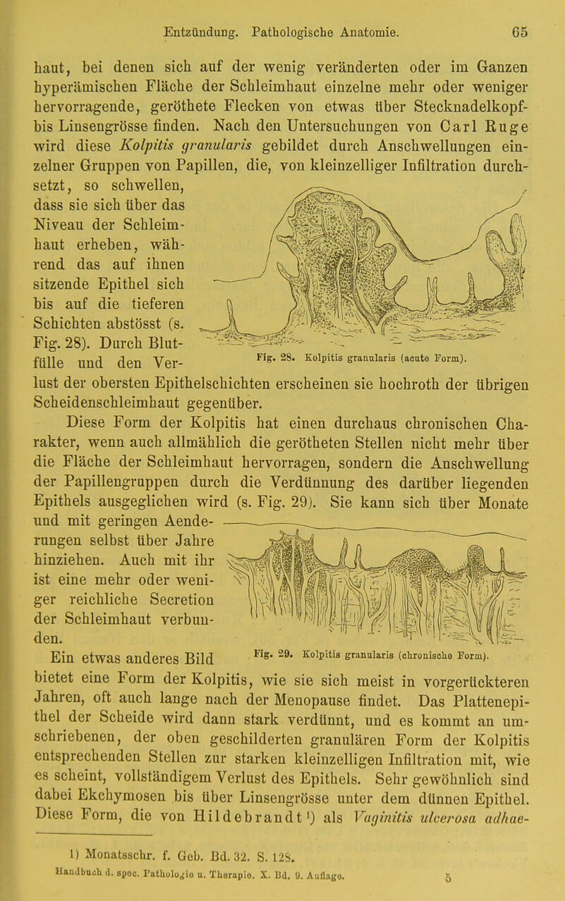 haut, bei denen sich auf der wenig veränderten oder im Ganzen hyperämischen Fläche der Schleimhaut einzelne mehr oder weniger hervorragende, geröthete Flecken von etwas über Stecknadelkopf- bis Linsengrösse finden. Nach den Untersuchungen von Carl Rüge wird diese Kolpitis granularis gebildet durch Anschwellungen ein- zelner Gruppen von Papillen, die, von kleinzelliger Infiltration durch- setzt, so schwellen, dass sie sich über das Niveau der Schleim- haut erheben, wäh- rend das auf ihnen sitzende Epithel sich bis auf die tieferen Schichten abstösst (s. Fig. 28). Durch Blut- fülle und den Ver- lust der obersten Epithelschichten erscheinen sie hochroth der übrigen Scheidenschleimhaut gegenüber. Diese Form der Kolpitis hat einen durchaus chronischen Cha- rakter, wenn auch allmählich die gerötheten Stellen nicht mehr über die Fläche der Schleimhaut hervorragen, sondern die Anschwellung der Papillengruppen durch die Verdünnung des darüber liegenden Epithels ausgeglichen wird (s. Fig. 29). Sie kann sich über Monate und mit geringen Aende- rungen selbst über Jahre hinziehen. Auch mit ihr ist eine mehr oder weni- Fig. 28. Kolpitis grannlaria (acute Form). ger reichliche Secretion der Schleimhaut verbun- den. Ein etwas anderes Bild FiS* 29* Kol£'ltis e^ularis (okronischs Form). bietet eine Form der Kolpitis, wie sie sich meist in vorgerückteren Jahren, oft auch lange nach der Menopause findet. Das Plattenepi- thel der Scheide wird dann stark verdünnt, und es kommt an um- schriebenen, der oben geschilderten granulären Form der Kolpitis entsprechenden Stellen zur starken kleinzelligen Infiltration mit, wie es scheint, vollständigem Verlust des Epithels. Sehr gewöhnlich sind dabei Ekchymosen bis über Linsengrösse unter dem dünnen Epithel. Diese Form, die von Hildebrandt1) als Vaginitis ulcerosa adltae- 1) Monataschr. f. Geb. Bd. 32. S. 12S. Handbuch (1. spoc. ratUolu<{io u. Tliorapio. X. Bd. 9. Auflago. 5