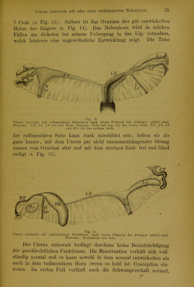 7 Cent. (s. Fig. 15). Seltner ist das Ovarium des gut entwickelten Horns das längere (s. Fig. 14). Das Nebenhorn wird in solchen Fällen am dicksten bei seinem Uebergang in das Lig. rotundum, welch letzteres eine ungewöhnliche Entwicklung zeigt. Die Tube Fig. 14. Uterus unicornis mit rudimentärem Netenhorn nach einem Präparat des Erlanger pathol.-anat. Museums. LH, LO, LT und LLr Horn, Ovarium, Tute und Lig. rot. der linken Seite, BH, RO, RT und RLr die der rechten Seite. der rudimentären Seite kann stark missbildet sein, indem sie als ganz kurzer, mit dem Uterus gar nicht zusammenhängender Strang aussen vom Ovarium sitzt und mit dem uterinen Ende frei und blind endigt (s. Fig. 15). Uterus unicornis mit rudimentärem Nebenhorn, nach einem Präparat des Erlanger pathol.-anat. Museums. Buchstaben wie oben. Der Uterus unicornis bedingt durchaus keine Beeinträchtigung der geschlechtlichen Funktionen. Die Menstruation verhält sich voll- ständig normal und es kann sowohl in dem normal entwickelten als auch in dem rudimentären Horn (wenn es hohl ist) Conception ein- treten. Im ersten Fall verläuft auch die Schwangerschaft normal 3* '