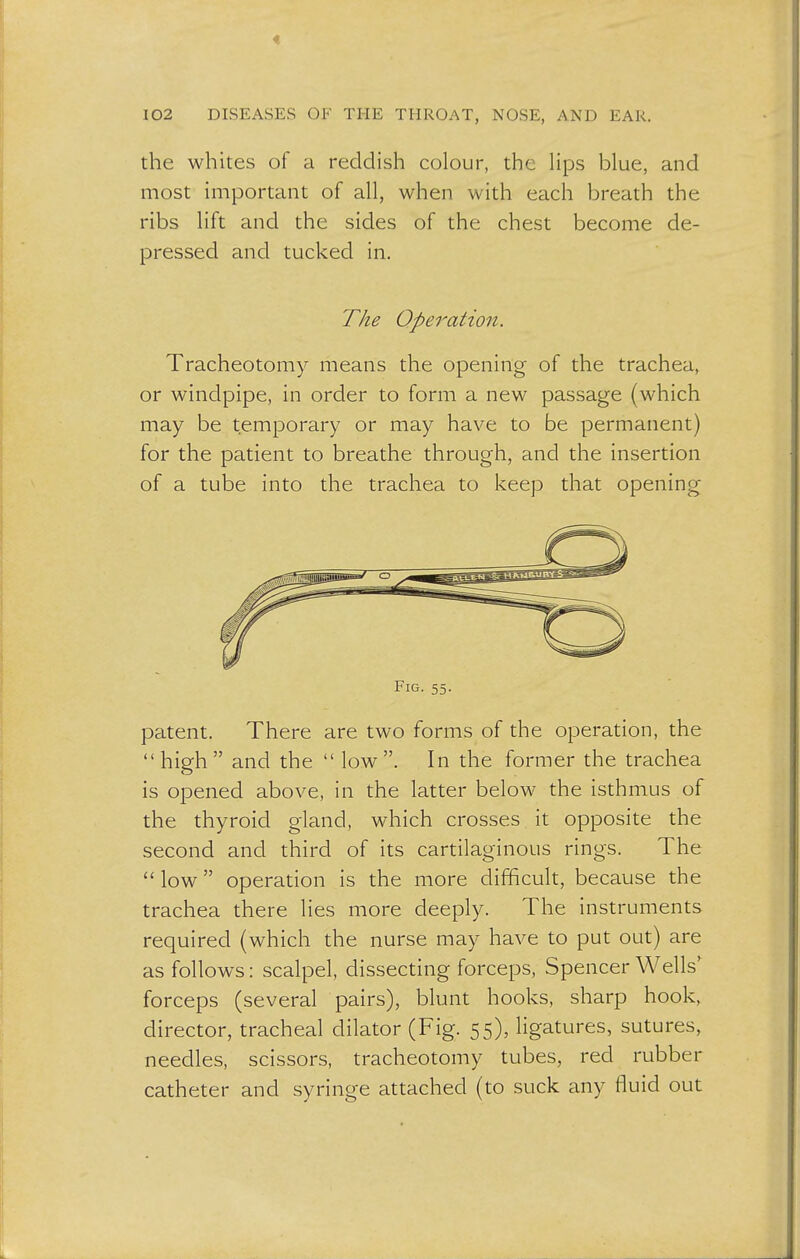 the whites of a reddish colour, the lips blue, and most important of all, when with each breath the ribs lift and the sides of the chest become de- pressed and tucked in. The Operation. Tracheotomy means the opening of the trachea, or windpipe, in order to form a new passage (which may be temporary or may have to be permanent) for the patient to breathe through, and the insertion of a tube into the trachea to keep that opening Fig. 55. patent. There are two forms of the operation, the high and the  low. In the former the trachea is opened above, in the latter below the isthmus of the thyroid gland, which crosses it opposite the second and third of its cartilaginous rings. The  low operation is the more difficult, because the trachea there lies more deeply. The instruments required (which the nurse may have to put out) are as follows: scalpel, dissecting forceps, Spencer Wells' forceps (several pairs), blunt hooks, sharp hook, director, tracheal dilator (Fig. 55), ligatures, sutures, needles, scissors, tracheotomy tubes, red rubber catheter and syringe attached (to suck any fluid out