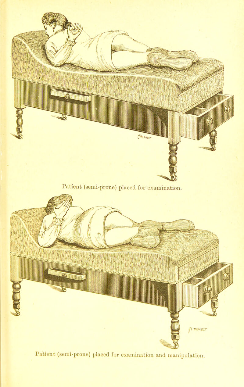 Patient (semi-prone) placed for examination. Patient (semi-prone) placed for examination and manipulation.