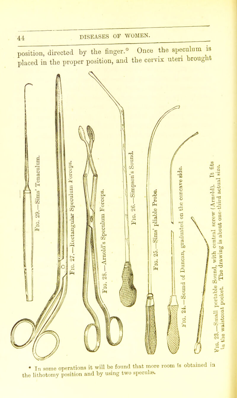 position, directed by the finger.3 Once the speculum placed in the proper position, and the cervix uteri broug