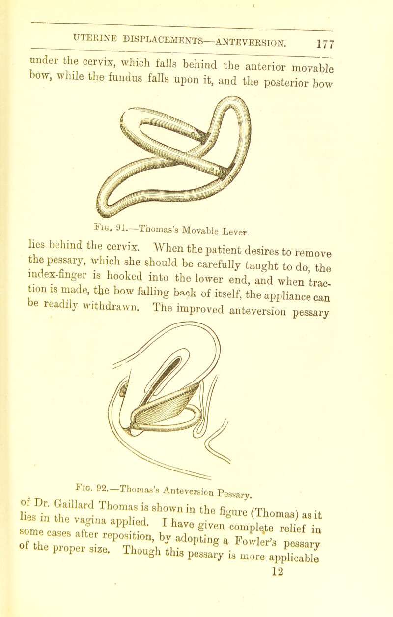 under the cervix, which falls behind the anterior movable bow, while the fundus falls upon it, and the posterior bow Fig, 91.—Thomas's Movable Lever, lies behind the cervix. When the patient desires to remove the pessary, which she should be carefully taught to do the index-finger is hooked into the lower end, and when trac- tion is made, the bow falling back of itself, the appliance can be readily withdrawn. The improved anteversion pessary Fig. 92.-Thomas's Anteversion Pessary 12